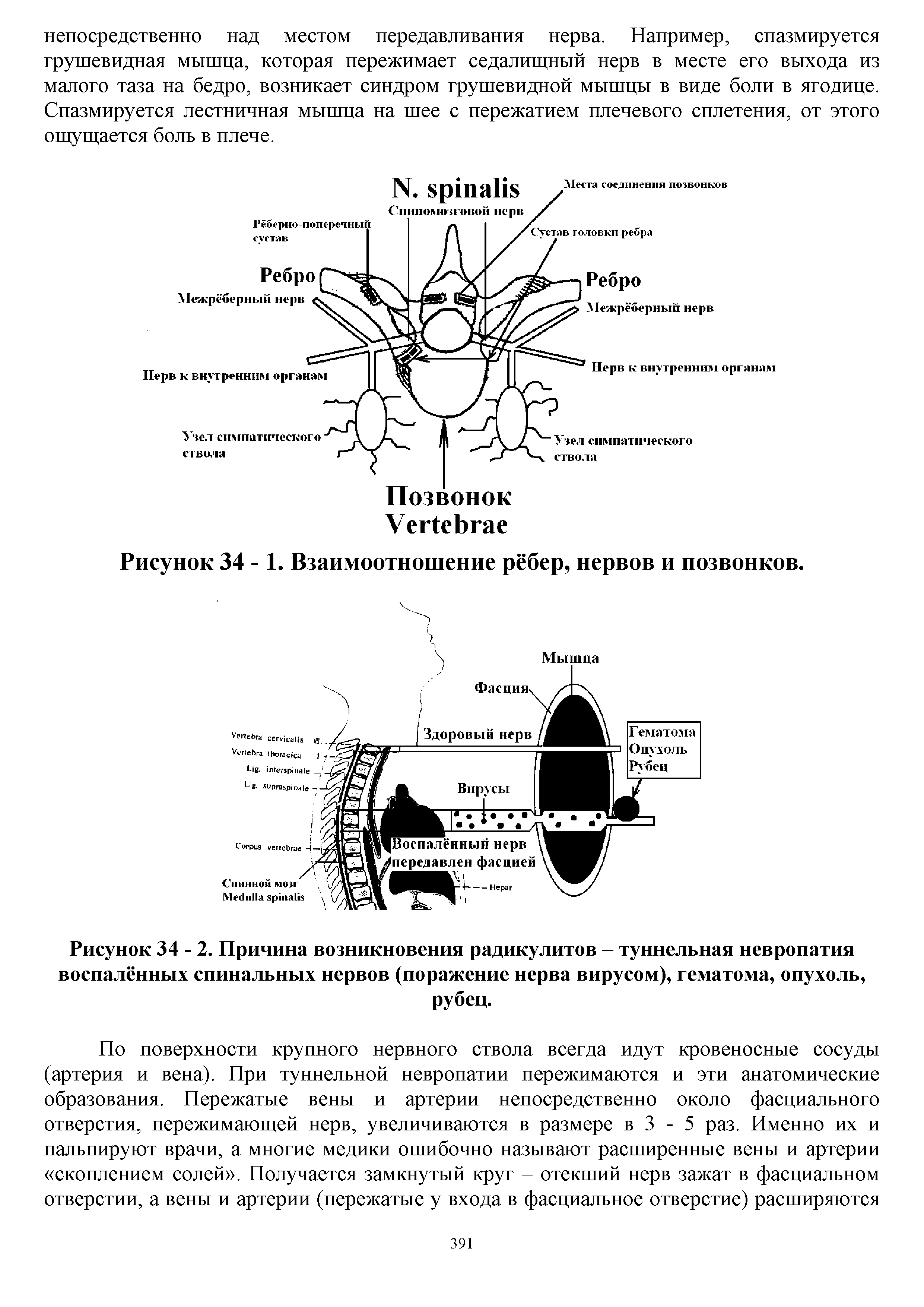 Рисунок 34 - 2. Причина возникновения радикулитов - туннельная невропатия воспалённых спинальных нервов (поражение нерва вирусом), гематома, опухоль, рубец.