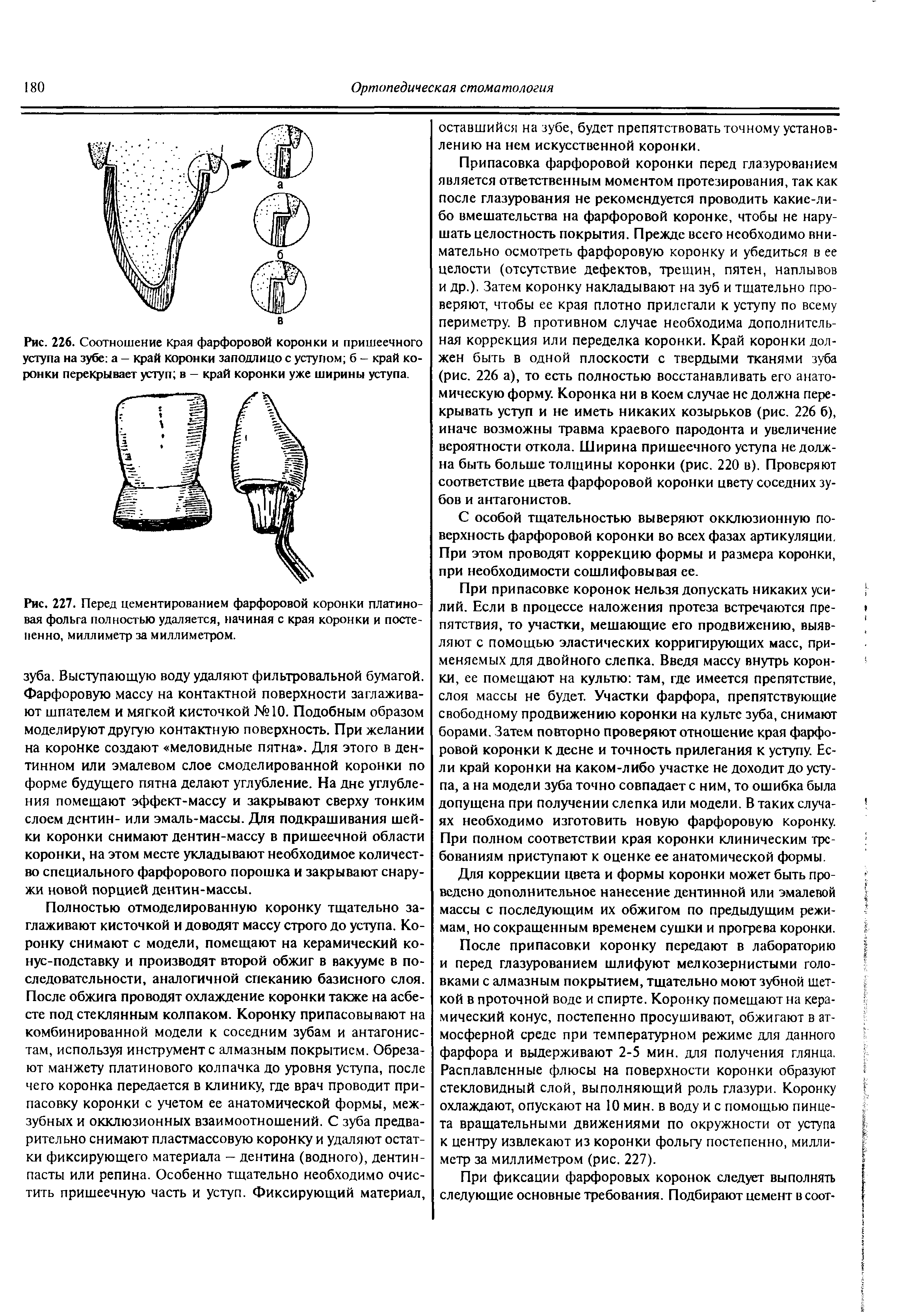 Рис. 227. Перед цементированием фарфоровой коронки платиновая фольга полностью удаляется, начиная с края коронки и постепенно, миллиметр за миллиметром.