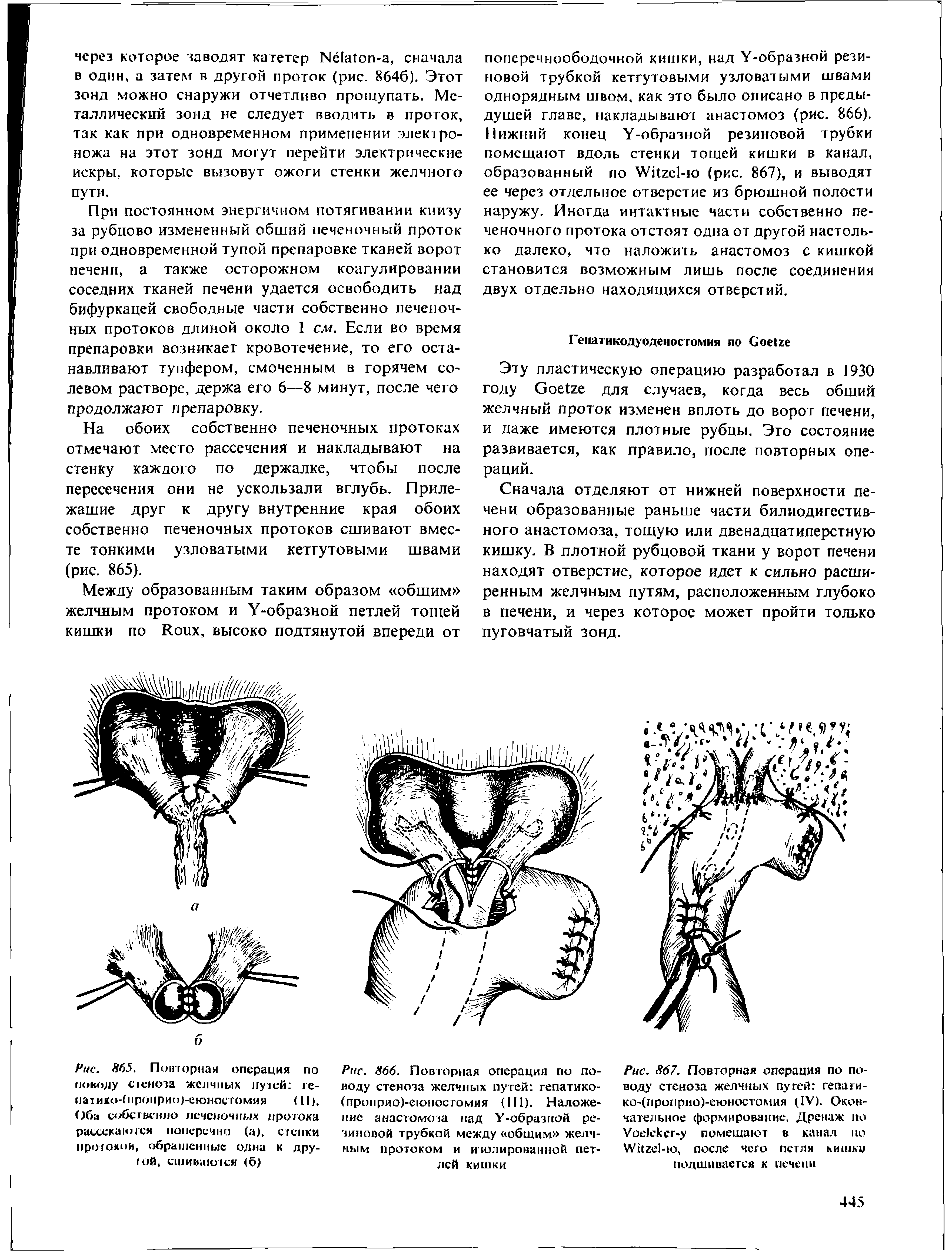 Рис. 865. Повторная операция по поводу стеноза желчных путей ге-иатик<.>-(11ропри<>)-еюностомия (II). Оба собственно печеночных протока рассекаю юя поперечно (а), стенки протокой, обращенные одна к другой, сшиваются (б)...