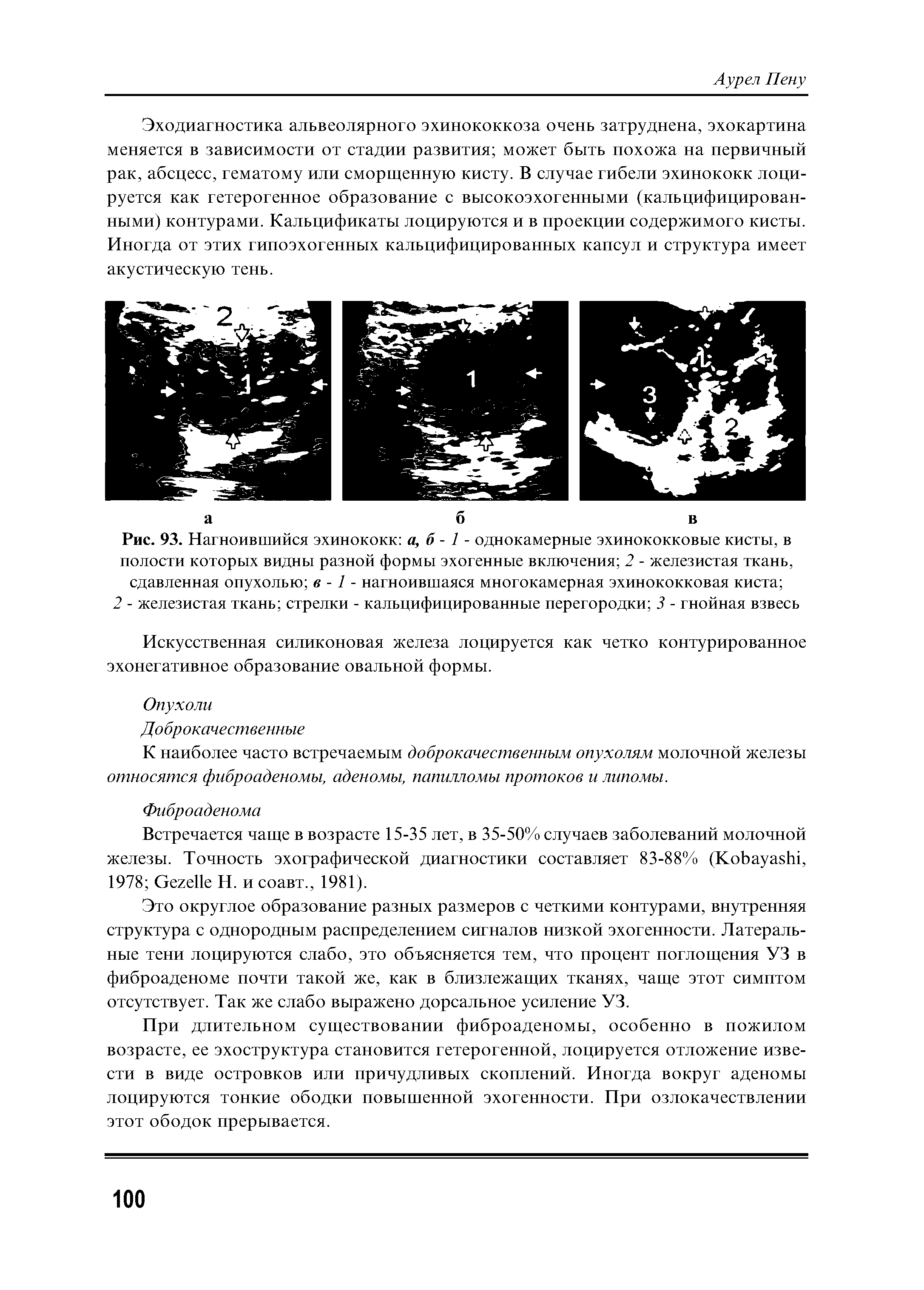 Рис. 93. Нагноившийся эхинококк а, б - 1 - однокамерные эхинококковые кисты, в полости которых видны разной формы эхогенные включения 2 - железистая ткань, сдавленная опухолью в -1 - нагноившаяся многокамерная эхинококковая киста ...