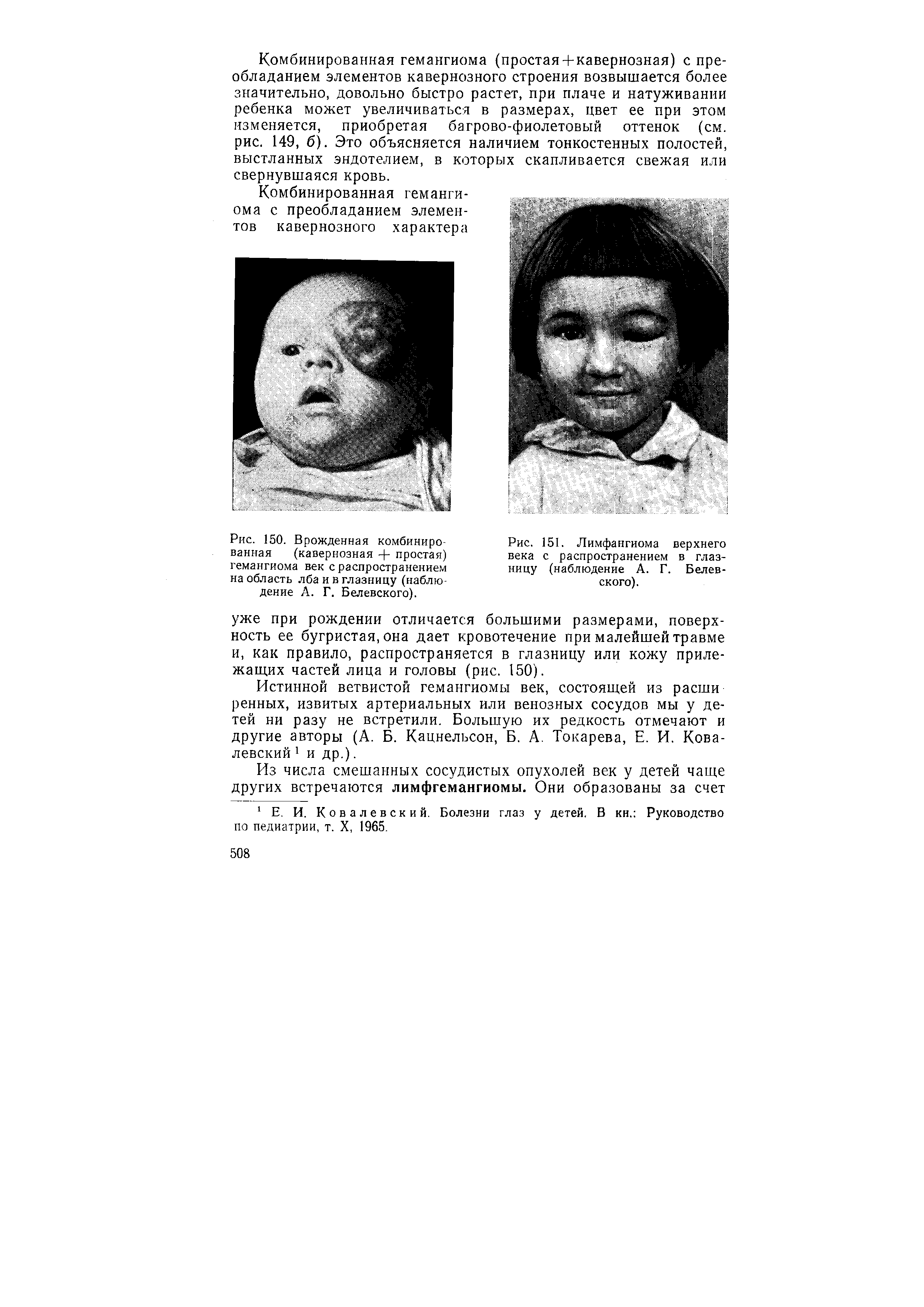 Рис. 151. Лимфангиома верхнего века с распространением в глазницу (наблюдение А. Г. Белевского).