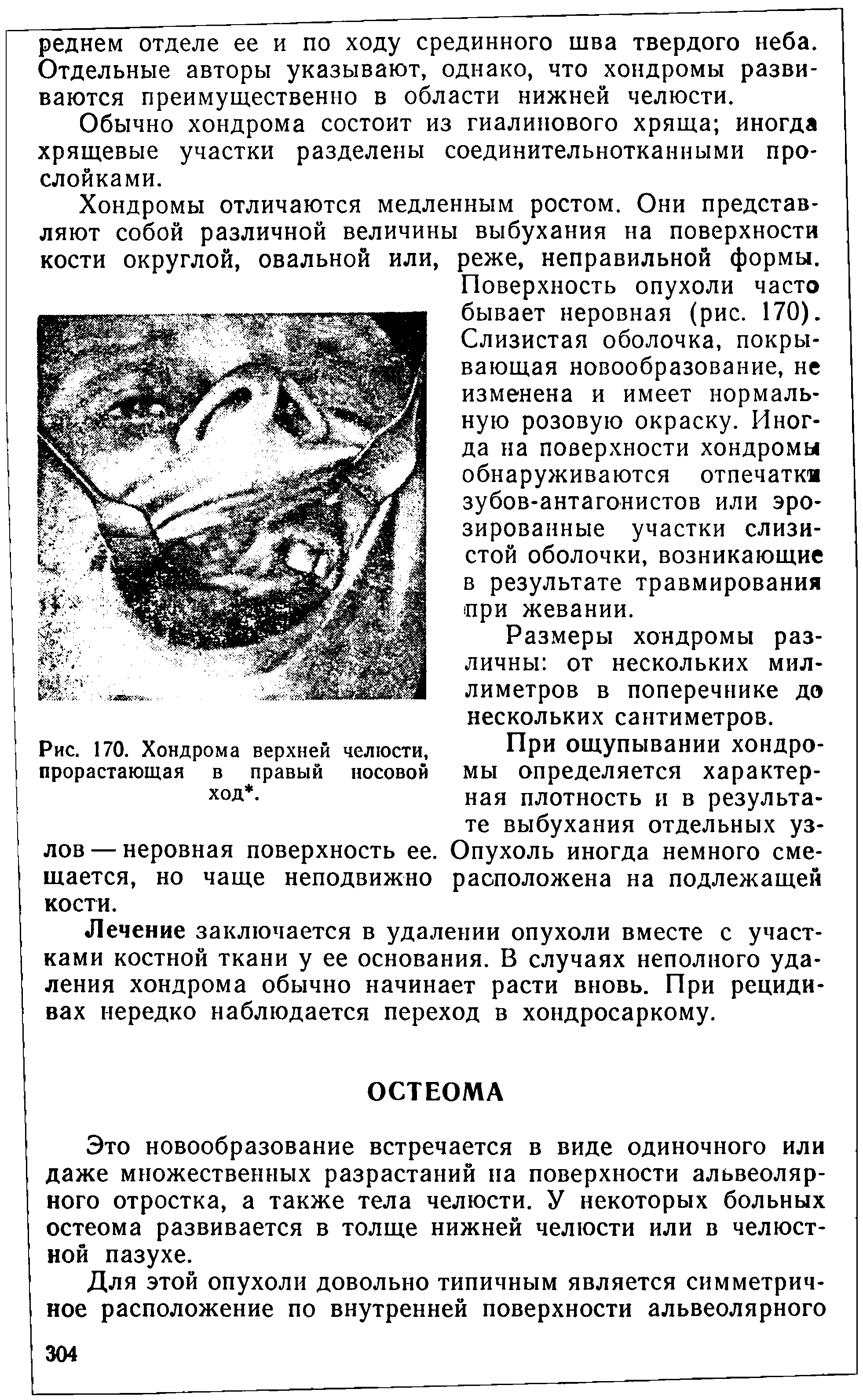 Рис. 170. Хондрома верхней челюсти, прорастающая в правый носовой ход. ...