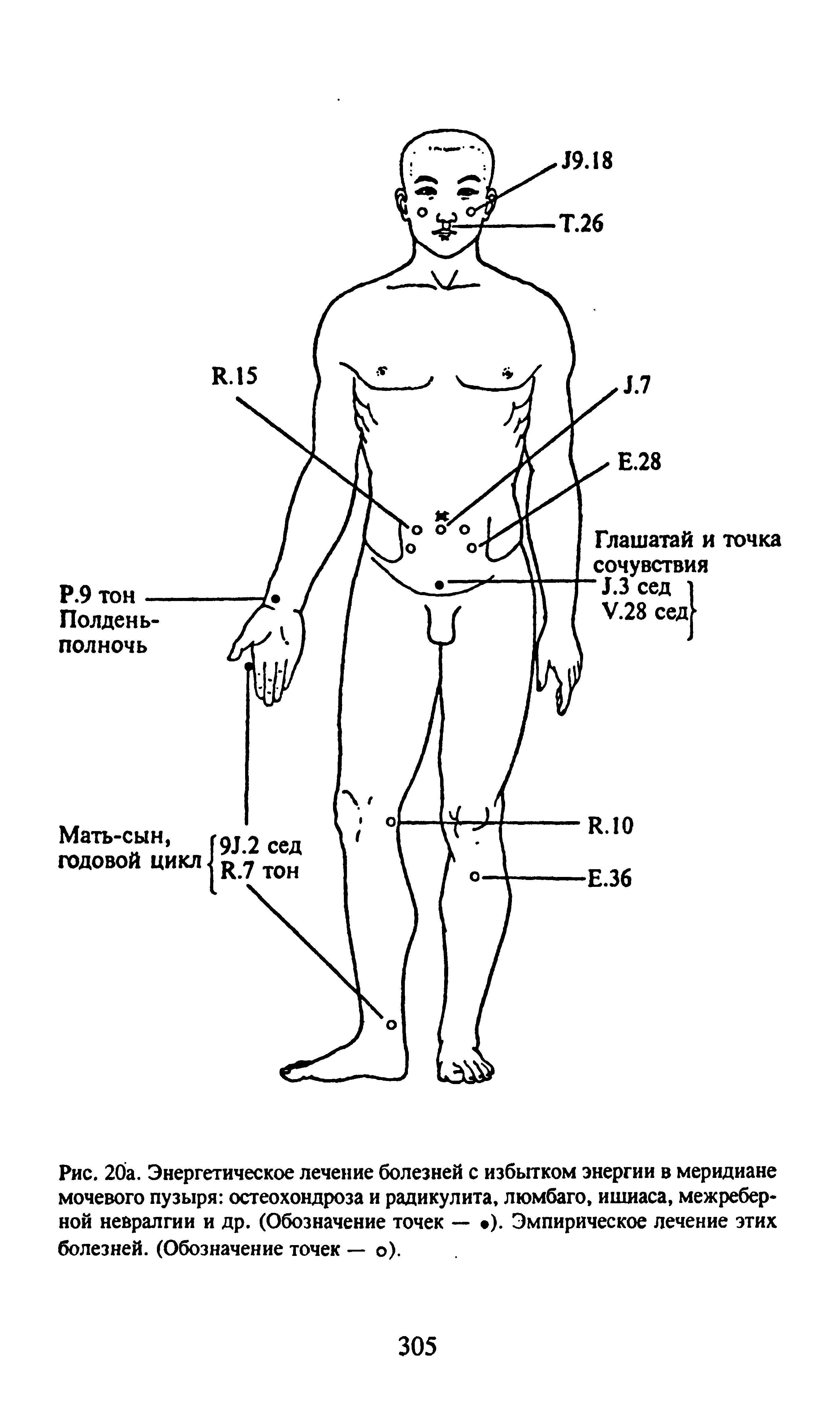 Рис. 20а. Энергетическое лечение болезней с избытком энергии в меридиане мочевого пузыря остеохондроза и радикулита, люмбаго, ишиаса, межреберной невралгии и др. (Обозначение точек — ). Эмпирическое лечение этих болезней. (Обозначение точек — о).