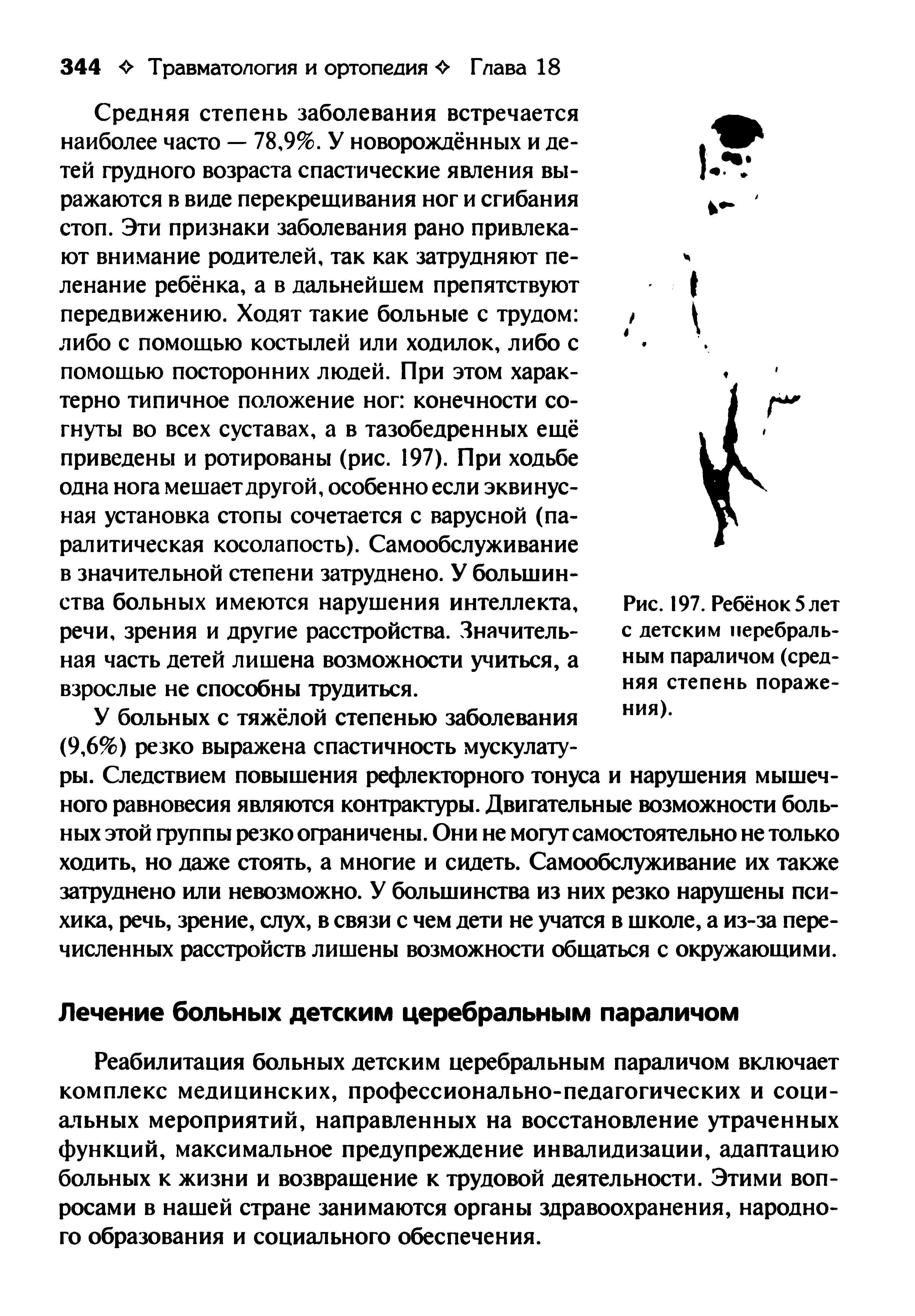 Рис. 197. Ребёнок 5 лет с детским церебральным параличом (средняя степень поражения).