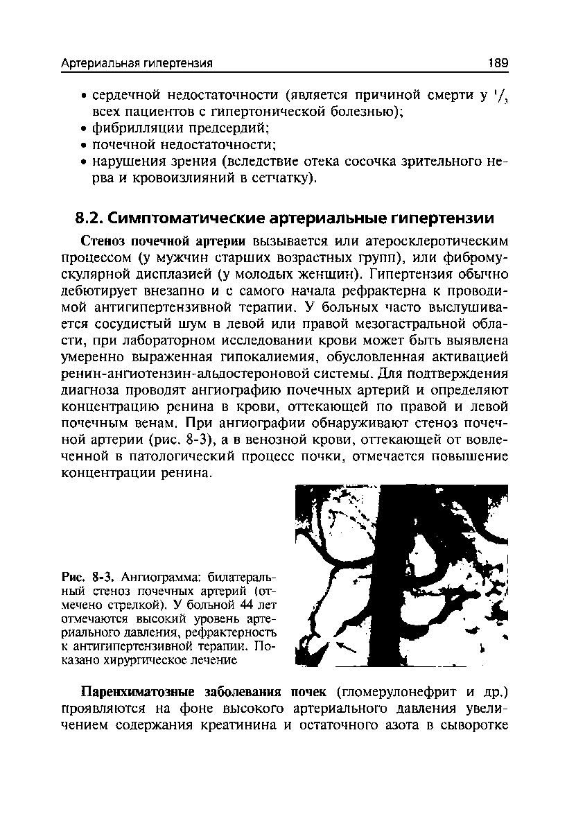 Рис. 8-3. Ангиограмма билатеральный стеноз почечных артерий (отмечено стрелкой). У больной 44 лет отмечаются высокий уровень артериального давления, рефрактерность к антигипертензивной терапии. По-...