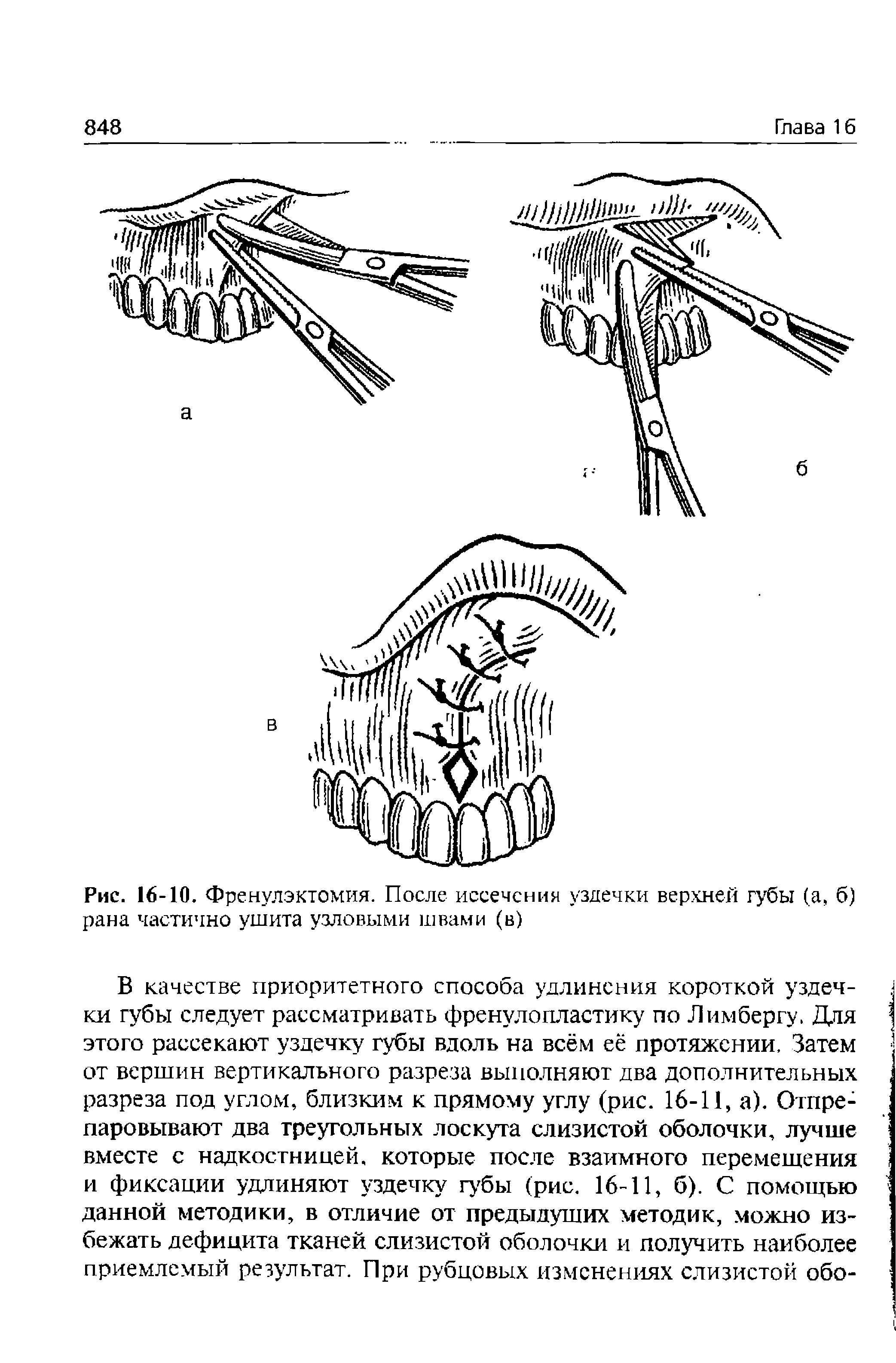 Рис. 16-10. Френулэктомия. После иссечения уздечки верхней губы (а, б) рана частично ушита узловыми швами (в)...