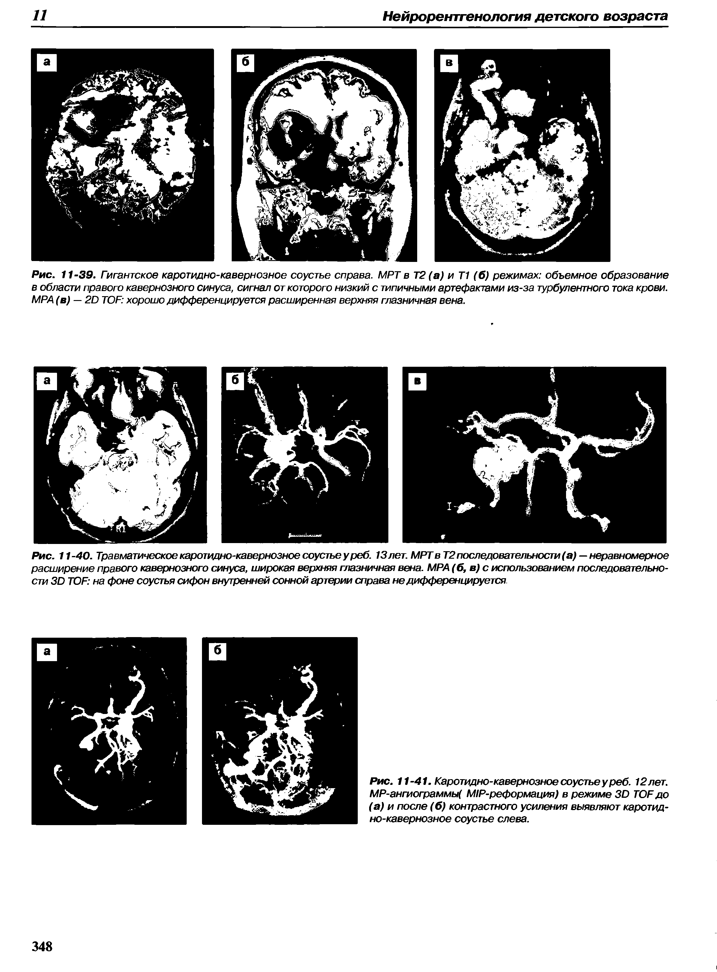 Рис. 11-41. Каротидно-кавернозное соустье у реб. 12лет. МР-ангиограммы( М1Р-реформация) в режиме 30 ТОР до (а) и после (б) контрастного усиления выявляют каротидно-кавернозное соустье слева.