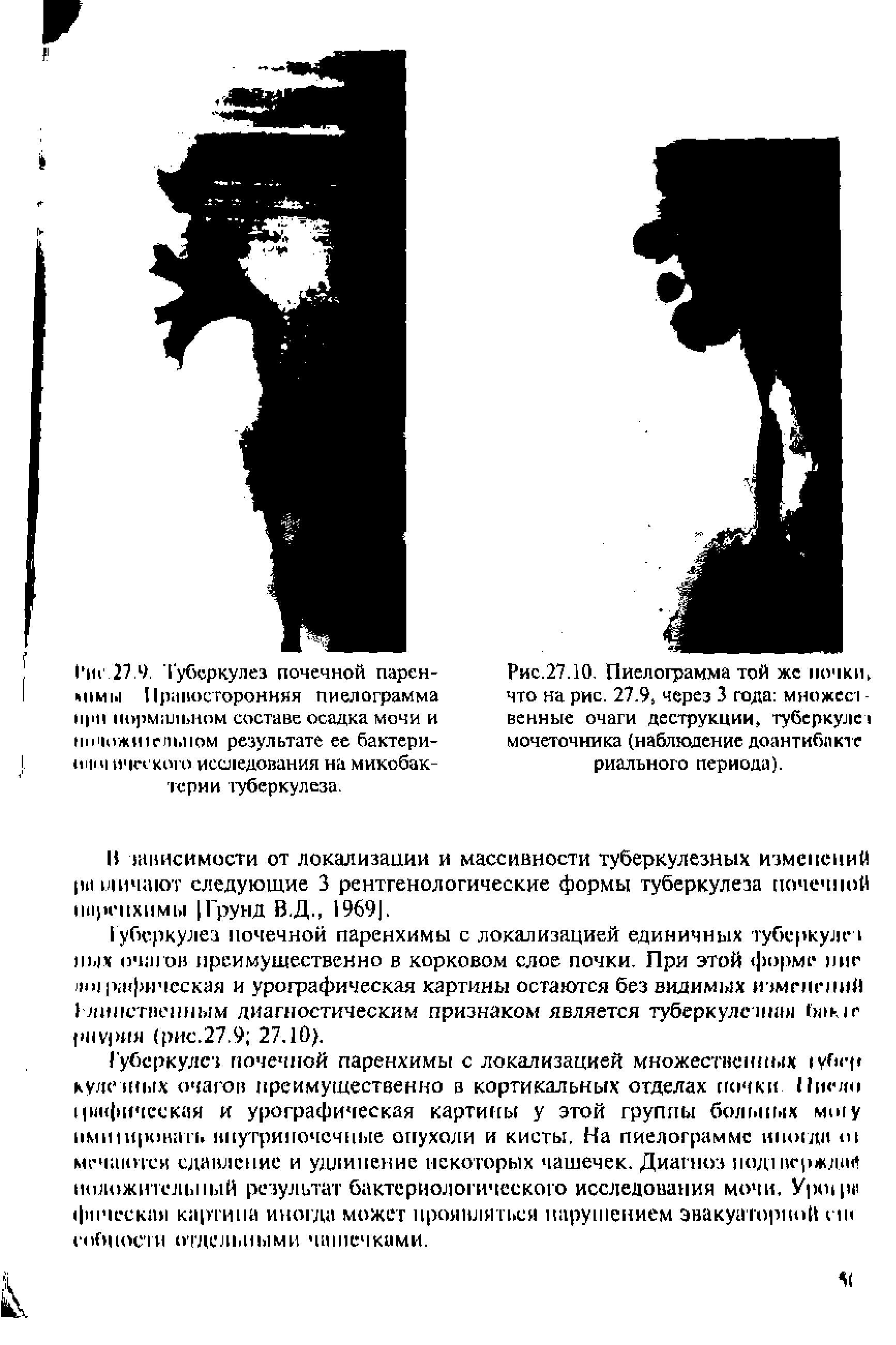 Рис.27.10. Пиелограмма той же почки, что на рис. 27.9 через 3 года множест -венные очаги деструкции, туберкулез мочеточника (наблюдение доантибакте риального периода).