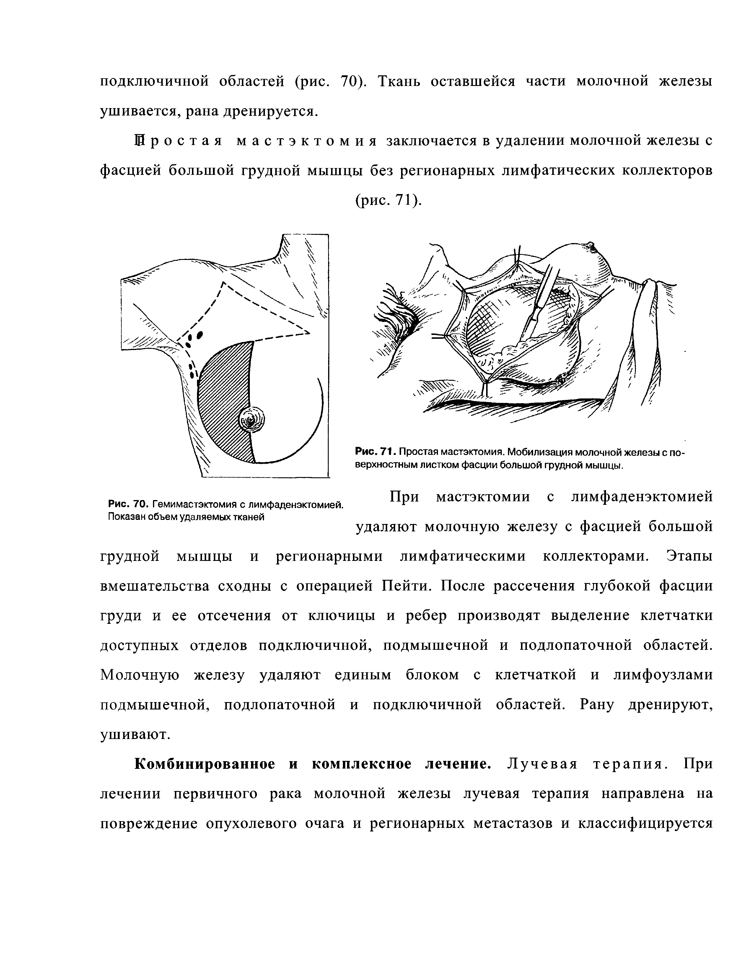 Рис. 71. Простая мастэктомия. Мобилизация молочной железы с поверхностным листком фасции большой грудной мышцы.