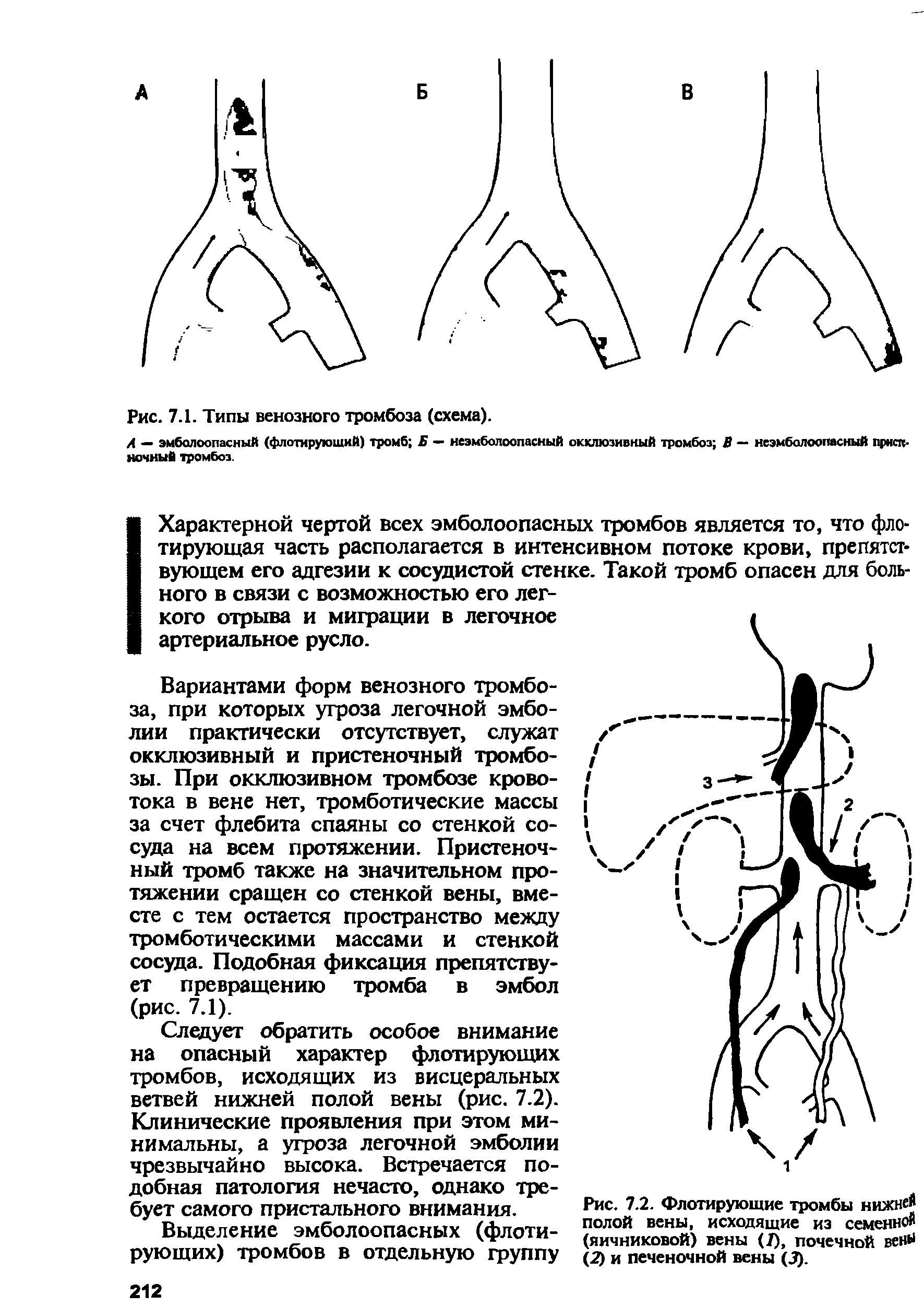 Рис. 7.2. Флотирующие тромбы нижней полой вены, исходящие из семенной (яичниковой) вены (7), почечной венН (2) и печеночной вены (3).