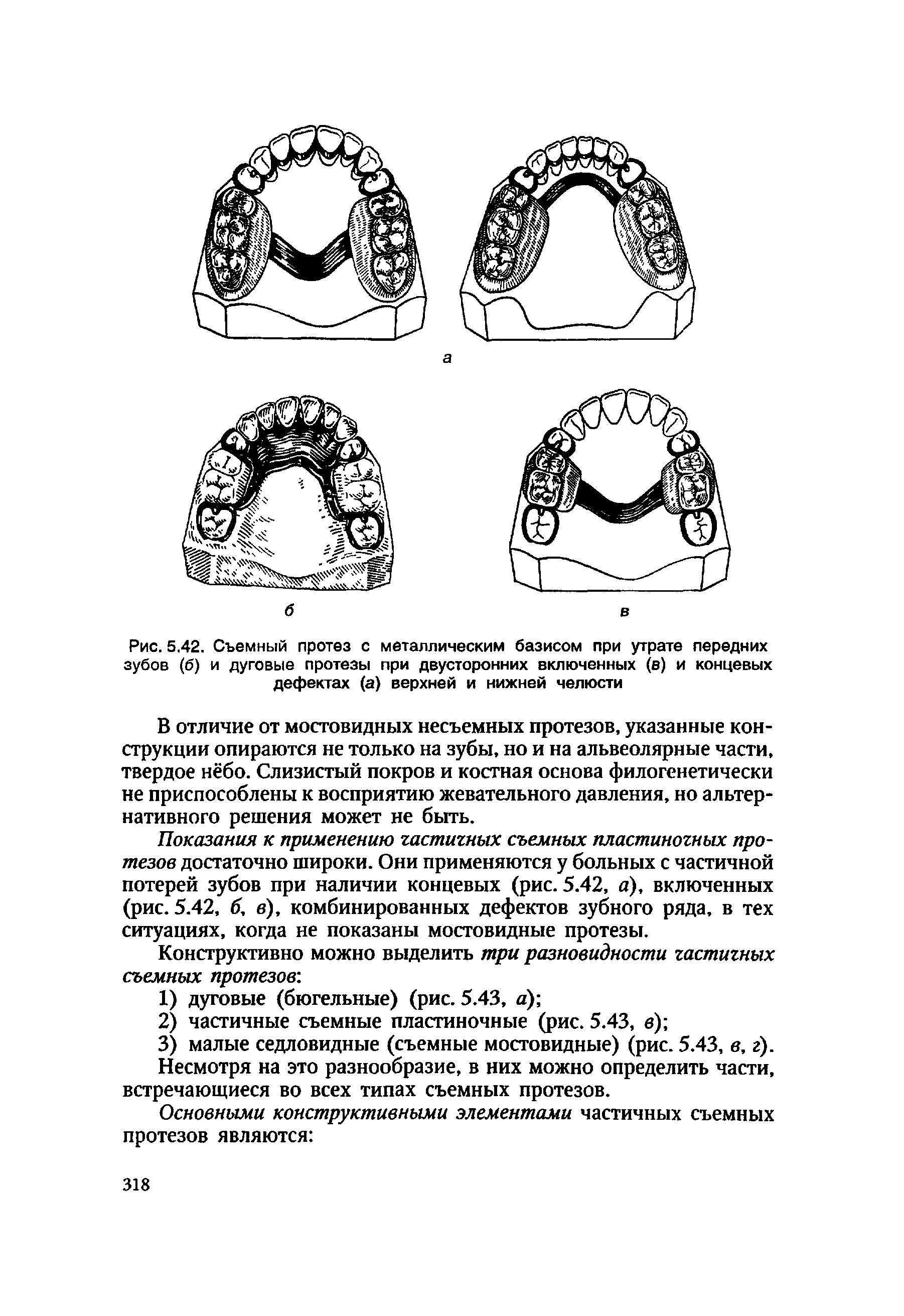 Рис. 5.42. Съемный протез с металлическим базисом при утрате передних зубов (б) и дуговые протезы при двусторонних включенных (в) и концевых дефектах (а) верхней и нижней челюсти...