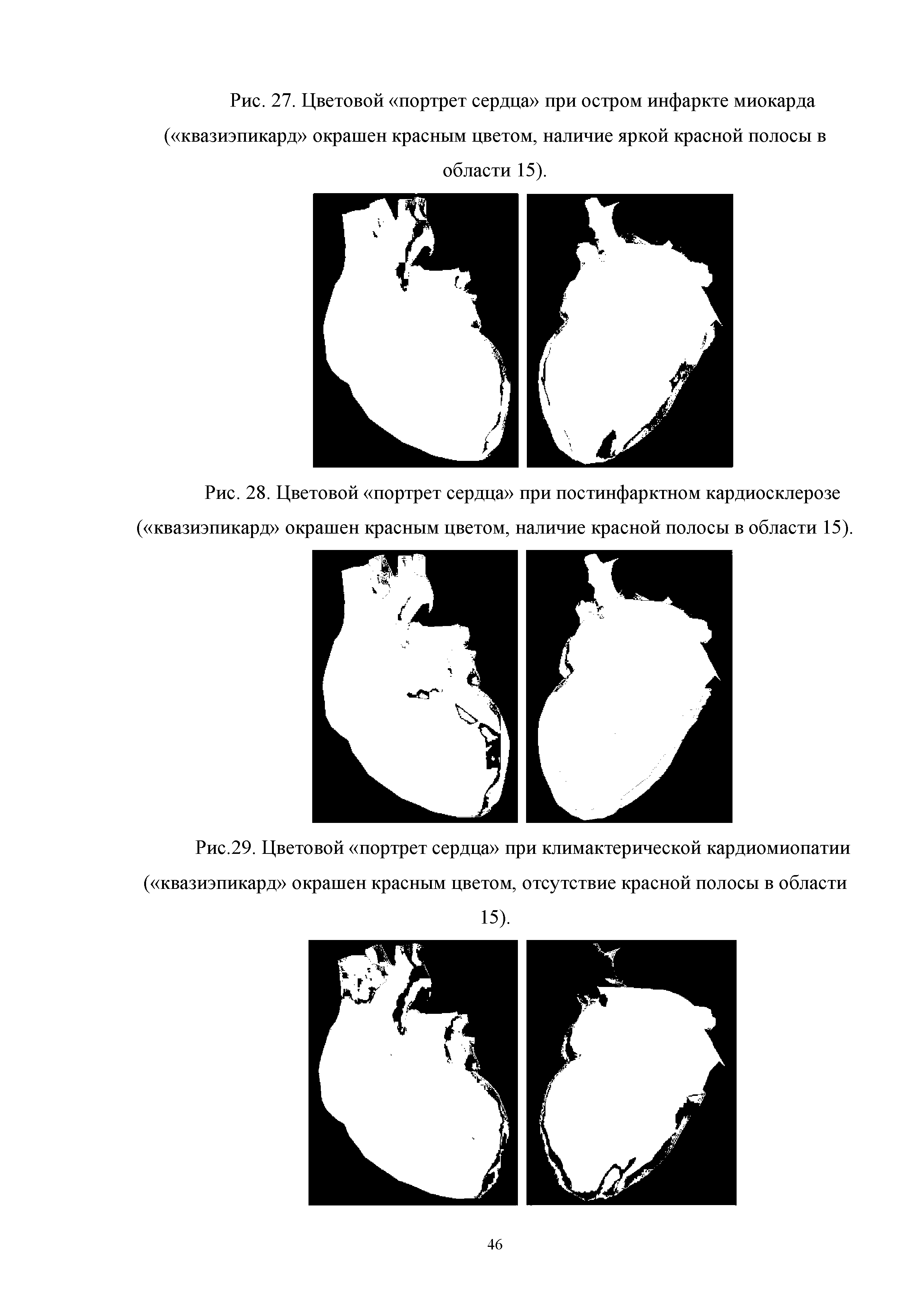 Рис.29. Цветовой портрет сердца при климактерической кардиомиопатии ( квазиэпикард окрашен красным цветом, отсутствие красной полосы в области...