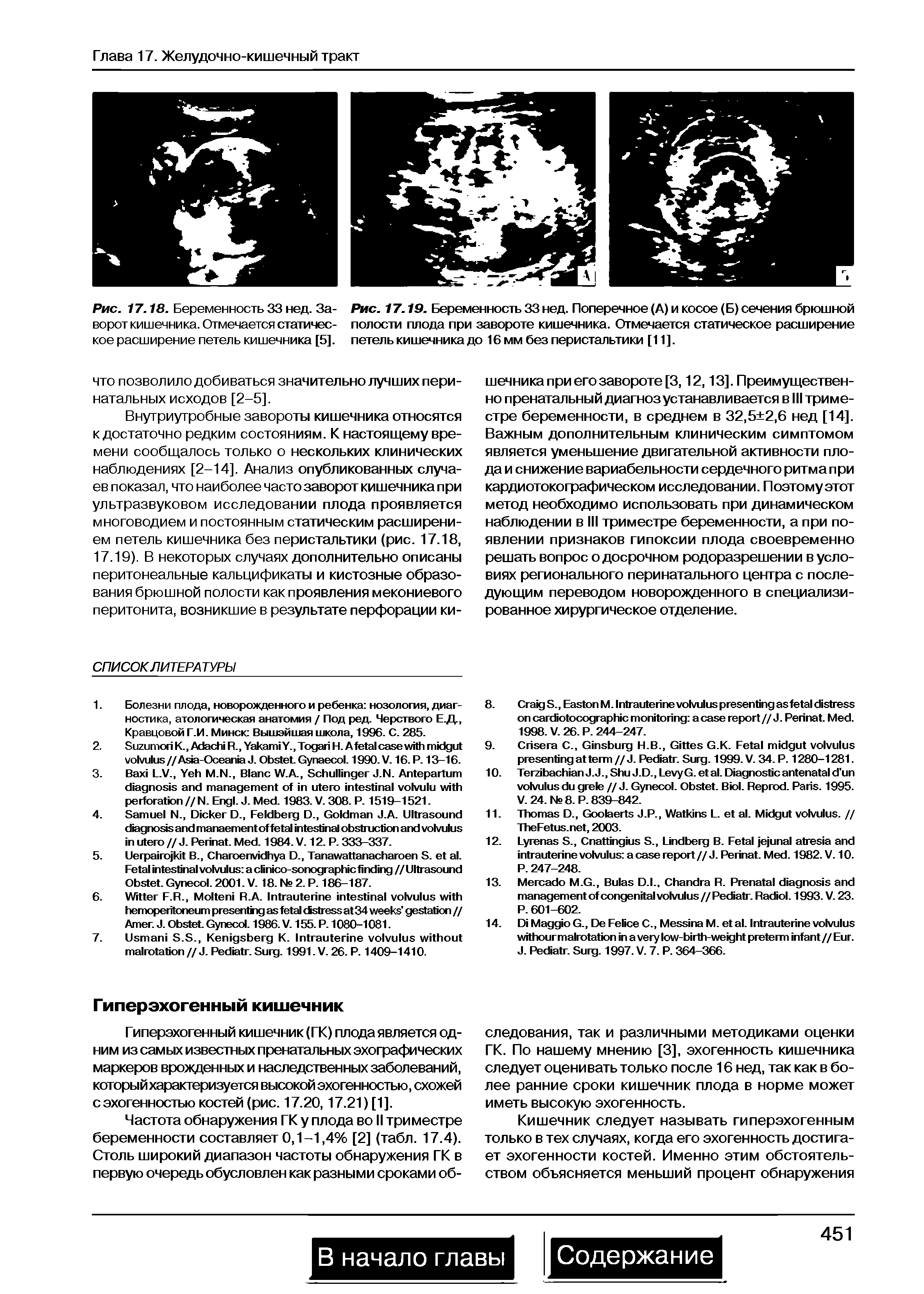 Рис. 17.19. Беременность 33 нед. Поперечное (А) и косое (Б) сечения брюшной полости плода при завороте кишечника. Отмечается статическое расширение петель кишечника до 16 мм без перистальтики [11].