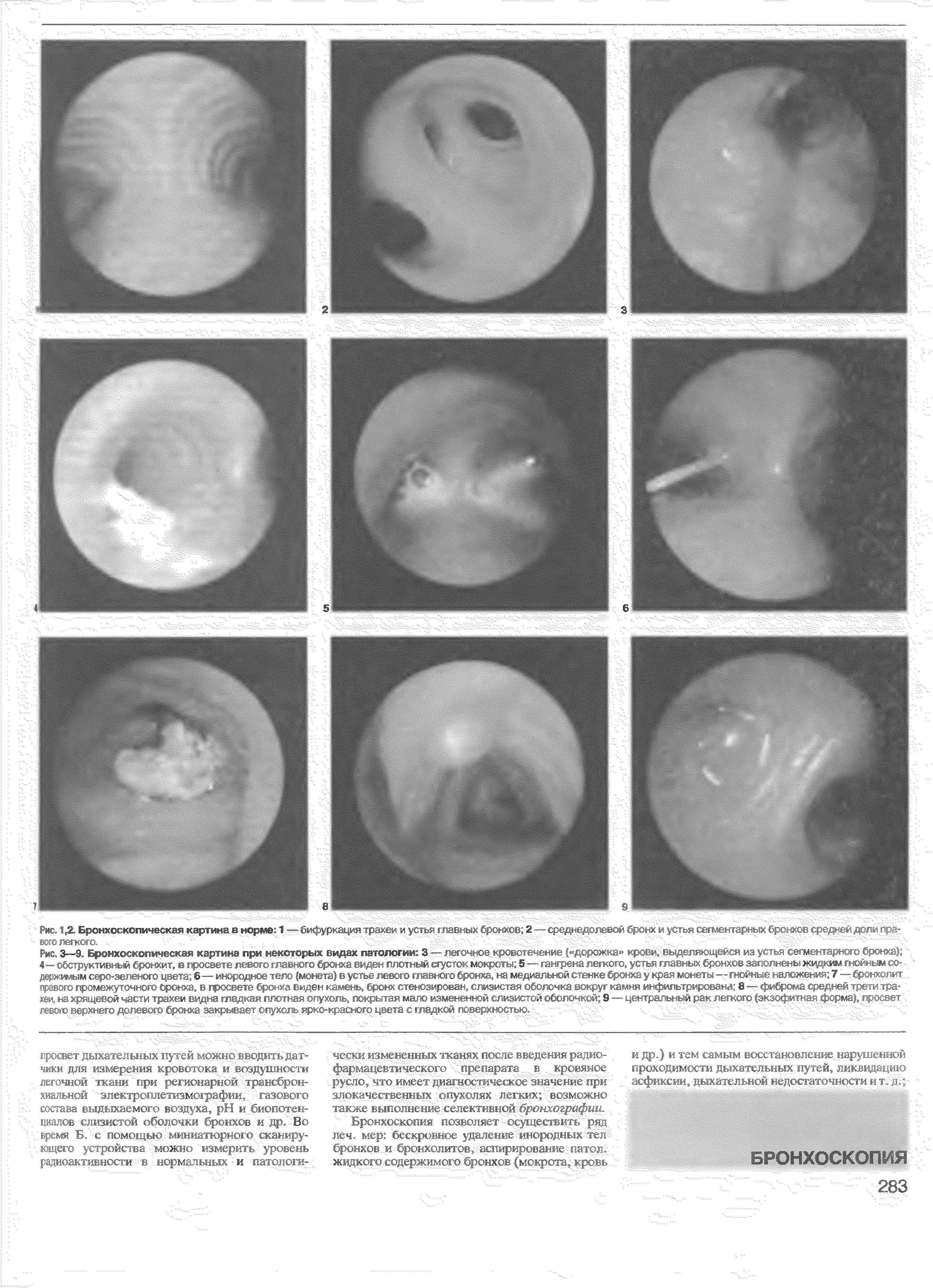 Рис. 1,2. Бронхоскопическая картина в норме 1 — бифуркация трахеи и устья главных бронхов 2 — среднедолевой бронх и устья сегментарны...