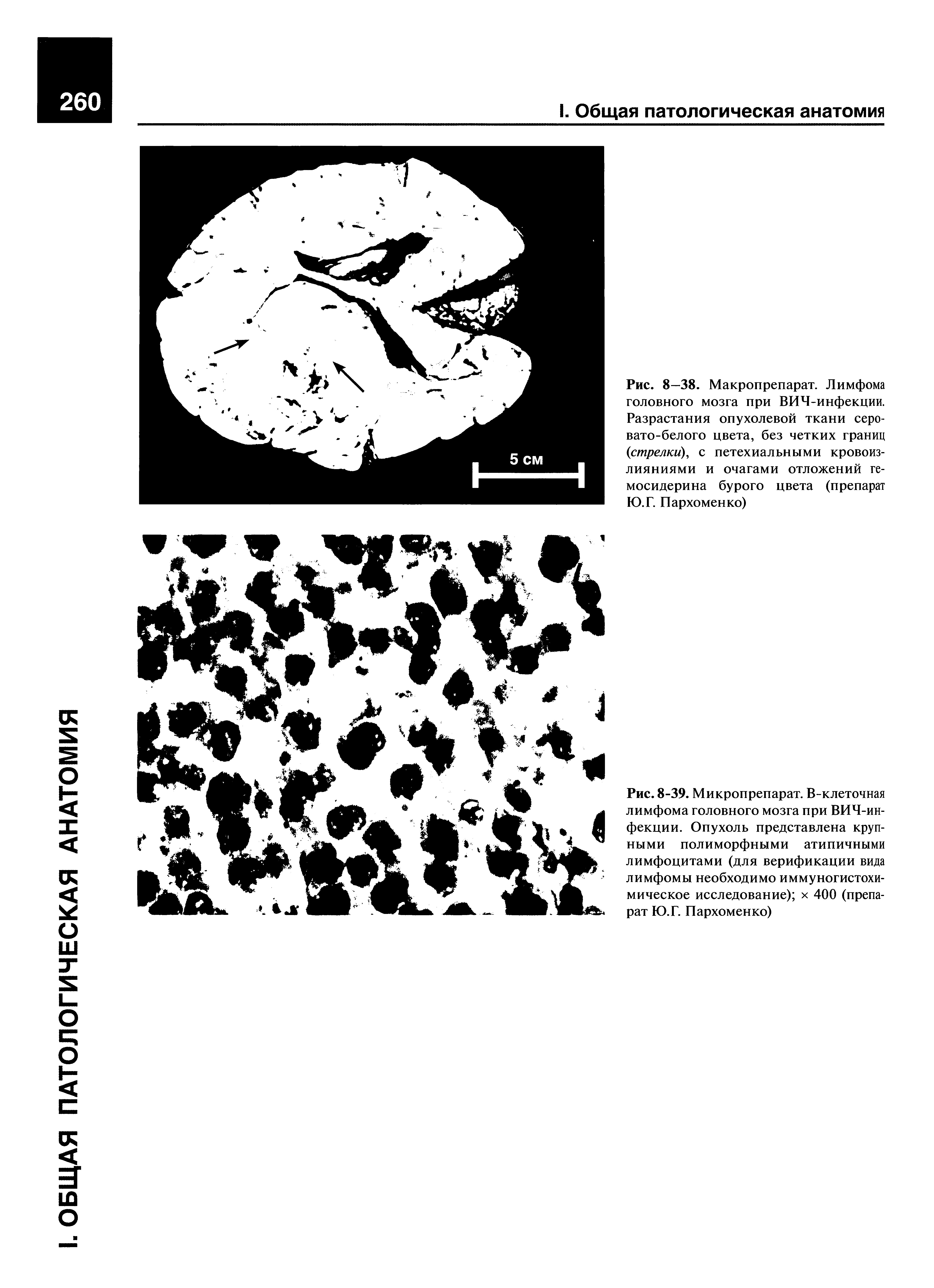 Рис. 8—38. Макропрепарат. Лимфома головного мозга при ВИЧ-инфекции. Разрастания опухолевой ткани серовато-белого цвета, без четких границ (стрелки), с петехиальными кровоизлияниями и очагами отложений гемосидерина бурого цвета (препарат Ю.Г. Пархоменко)...