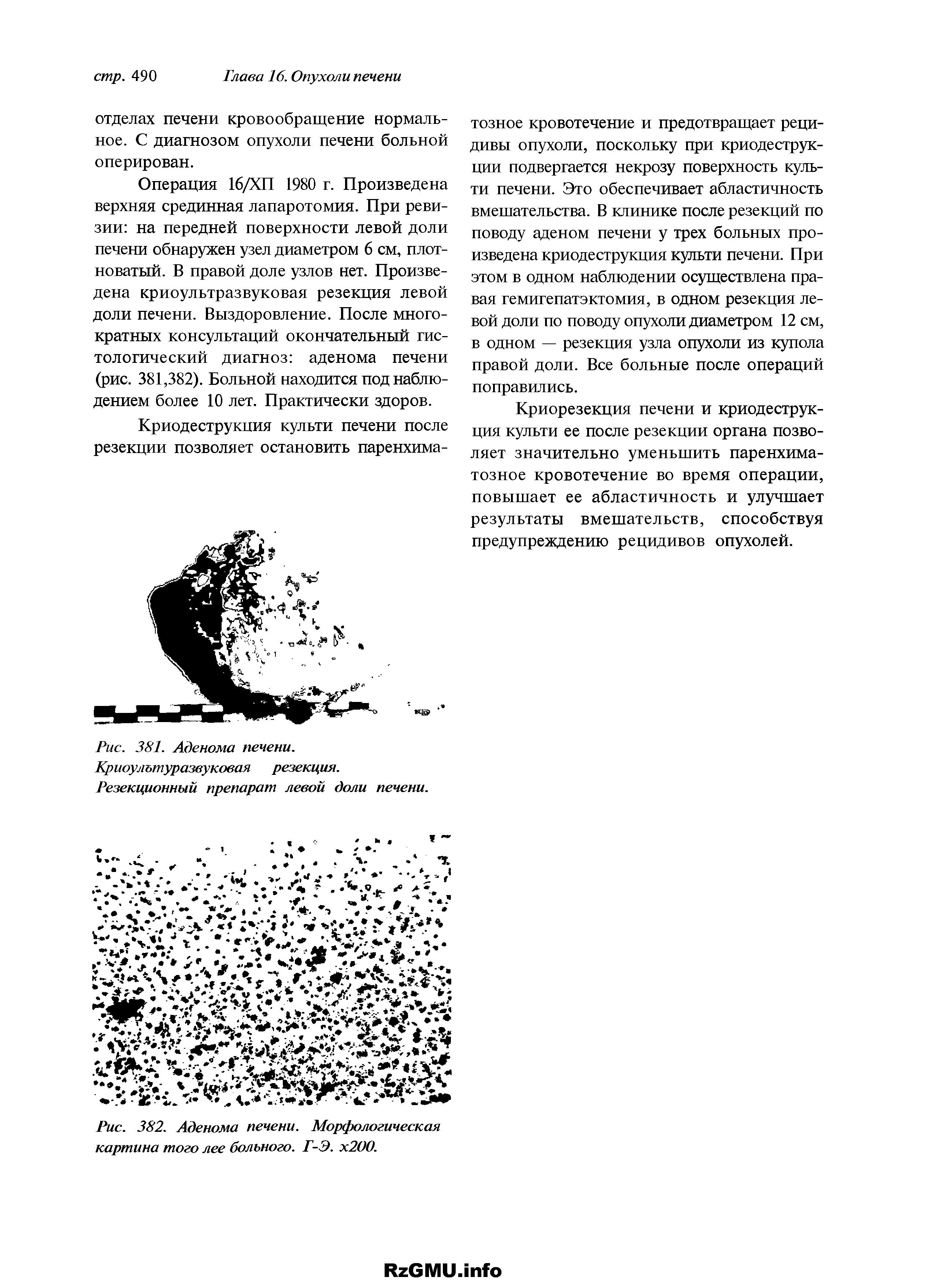 Рис. 382. Аденома печени. Морфологическая картина того лее больного. Г-Э. х200.