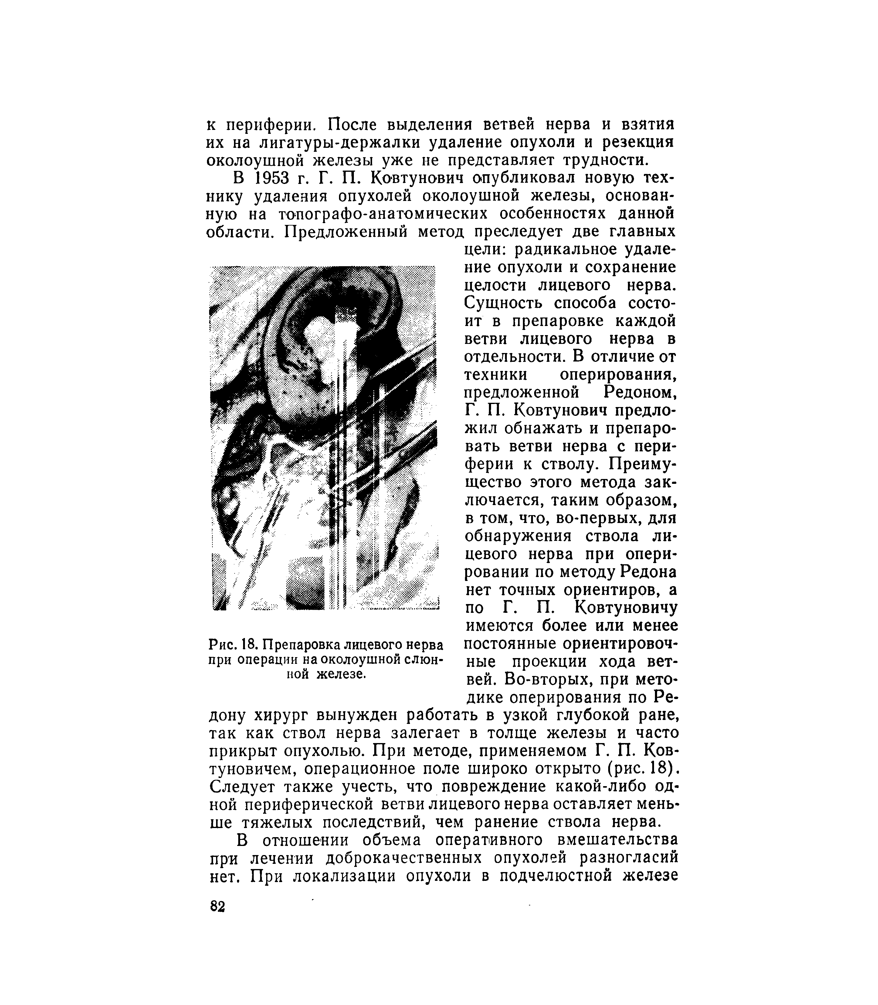 Рис. 18. Препаровка лицевого нерва при операции на околоушной слюнной железе.