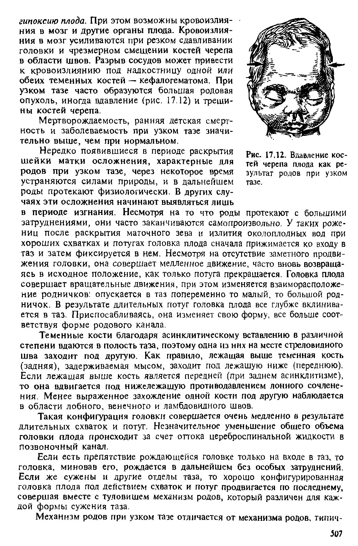 Рис. 17.12. Вдавление костей черепа плода как результат родов при узком тазе.