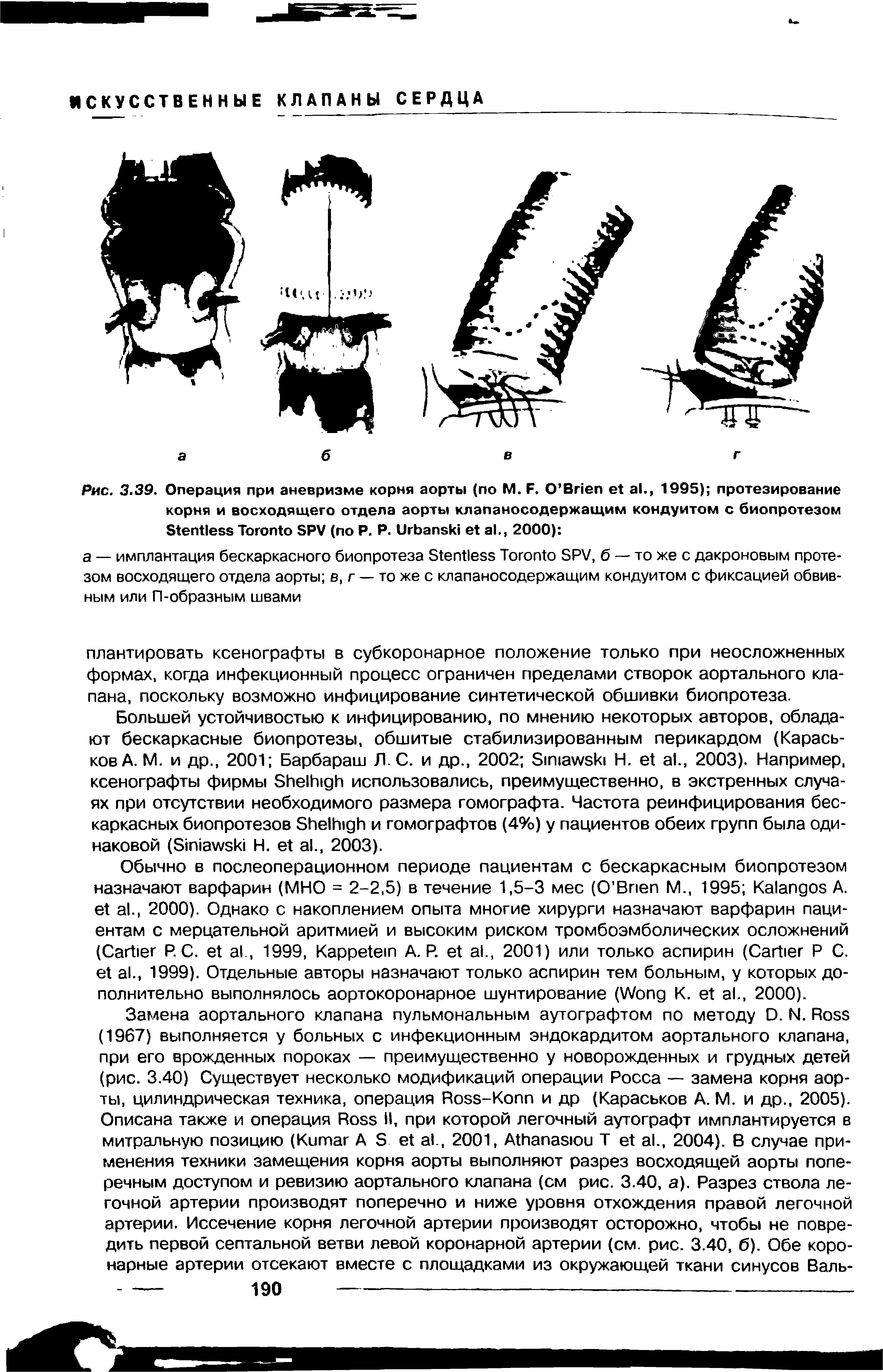 Рис. 3.39. Операция при аневризме корня аорты (по М. F. O B ., 1995) протезирование корня и восходящего отдела аорты клапаносодержащим кондуитом с биопротезом S T SPV ( P. P. U ., 2000) ...