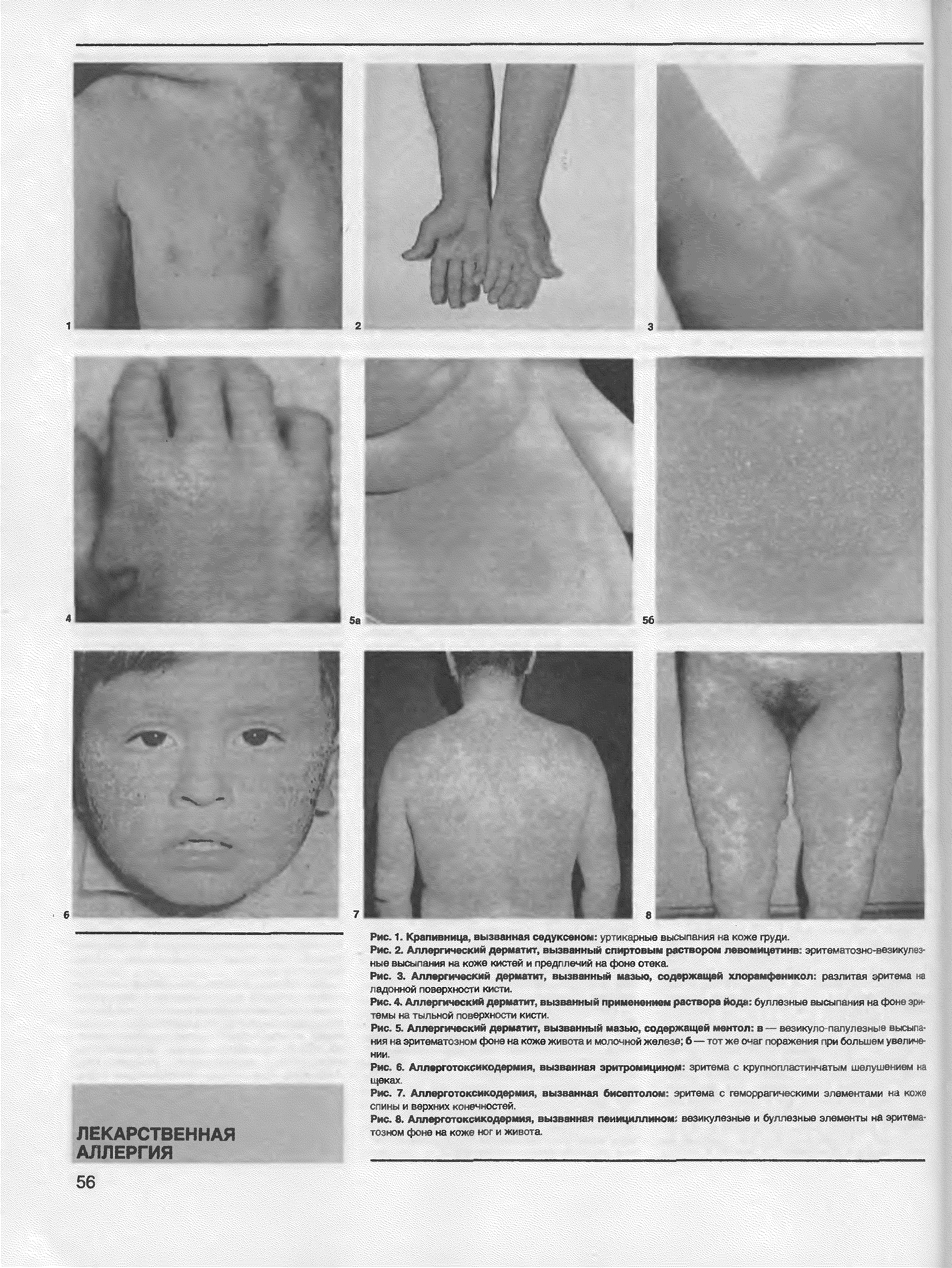 Рис. 7. Аллерготоксикодермия, вызванная бисептолом эритема с геморрагическими элементами на коже спины и верхних конечностей.