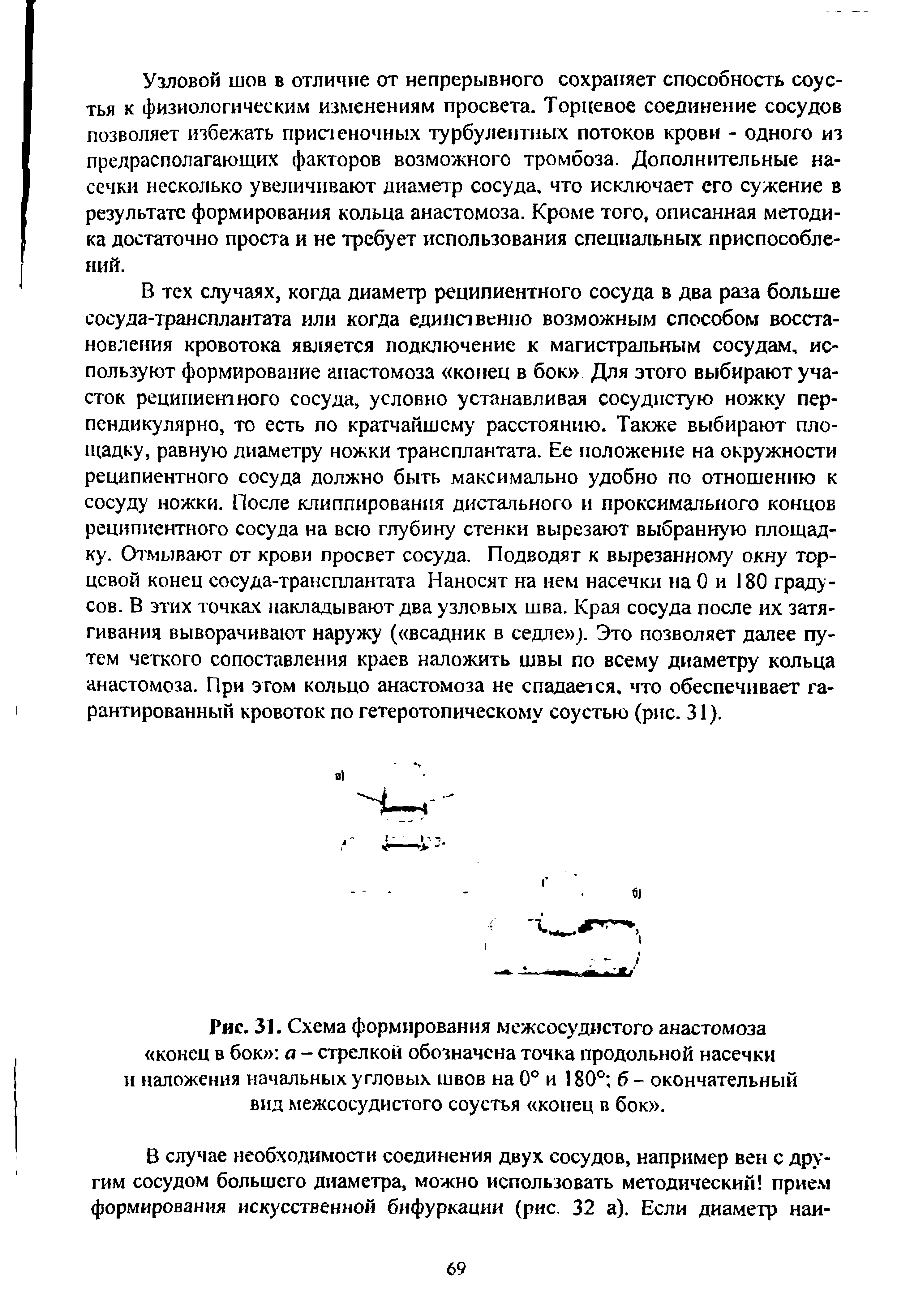 Рис. 31. Схема формирования межсосудистого анастомоза конец в бок а - стрелкой обозначена точка продольной насечки и наложения начальных угловых швов на 0° и 180° б - окончательный вид межсосудистого соустья конец в бок .