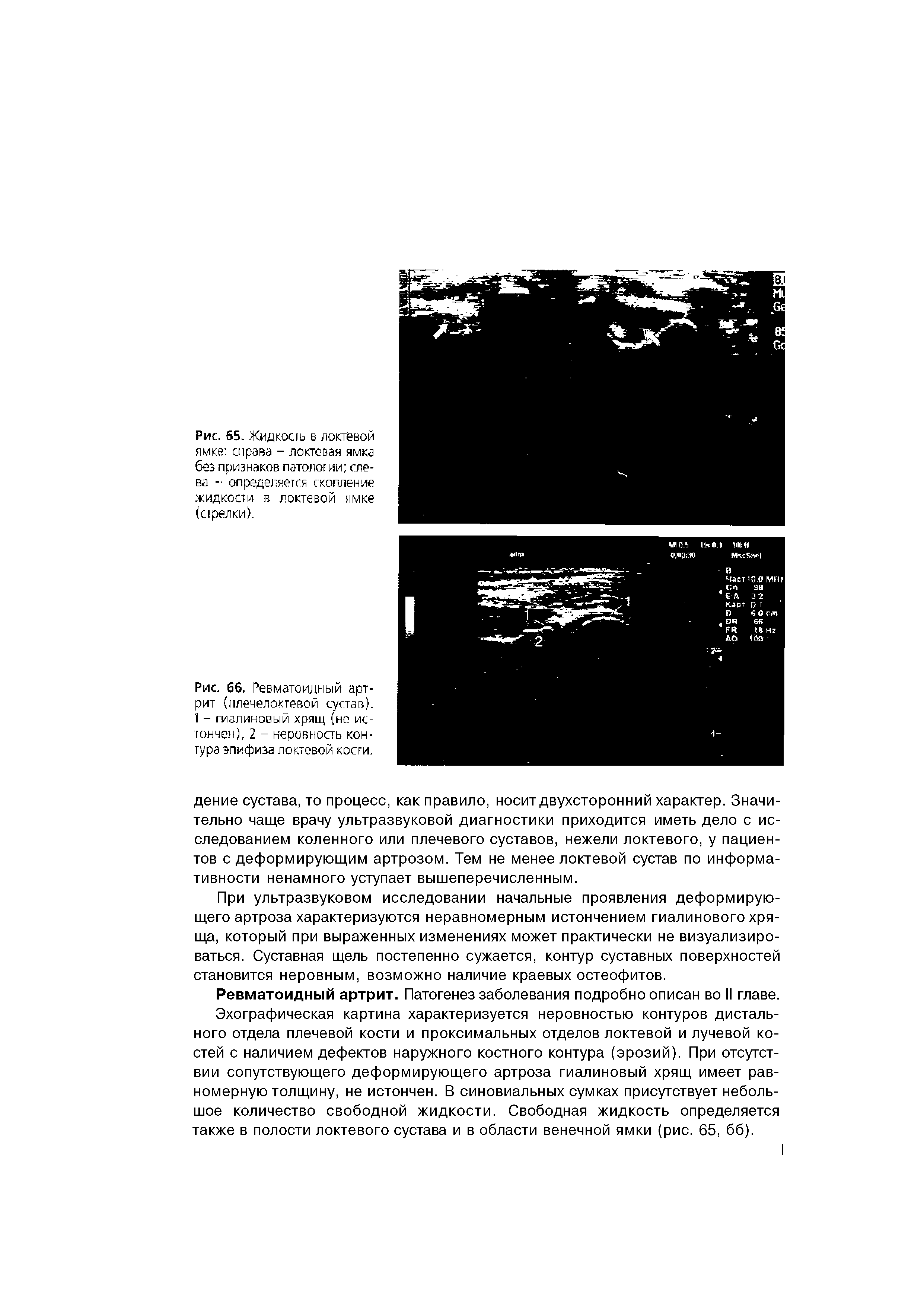 Рис. 66. Ревматоидный артрит (плечелоктевой сустав). 1 - гиалиновый хрящ (но истончен), 2 - неровность контура эпифиза локтевой кости.