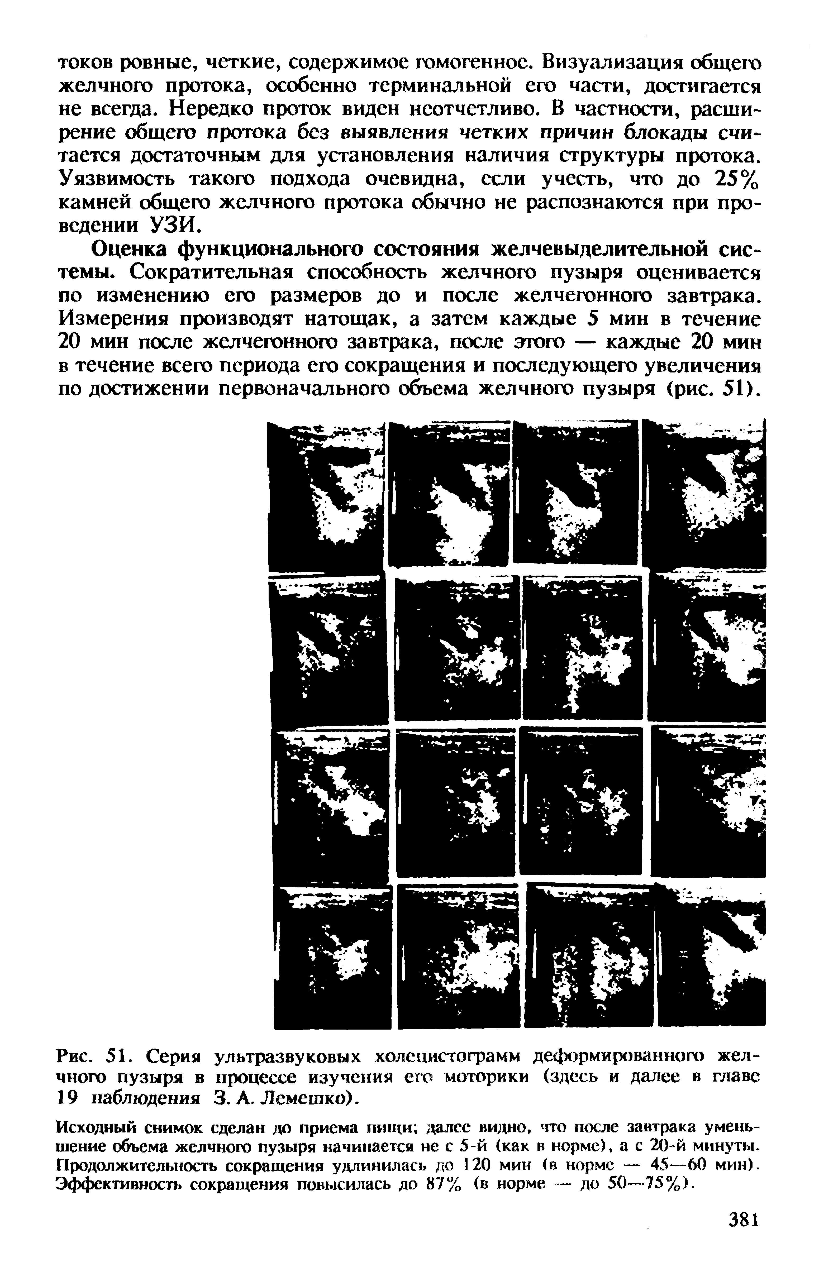 Рис. 51. Серия ультразвуковых холецистограмм деформированного желчного пузыря в процессе изучения его моторики (здесь и далее в главе 19 наблюдения 3. А. Лемешко).