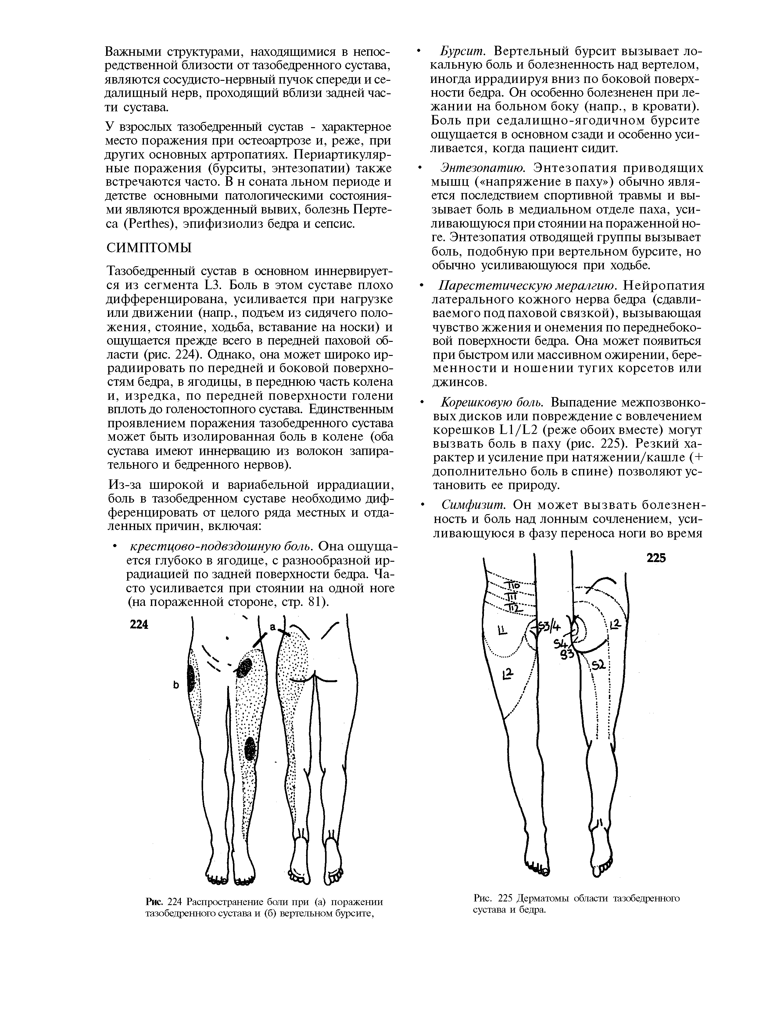 Рис. 224 Распространение боли при (а) поражении тазобедренного сустава и (б) вертельном бурсите,...