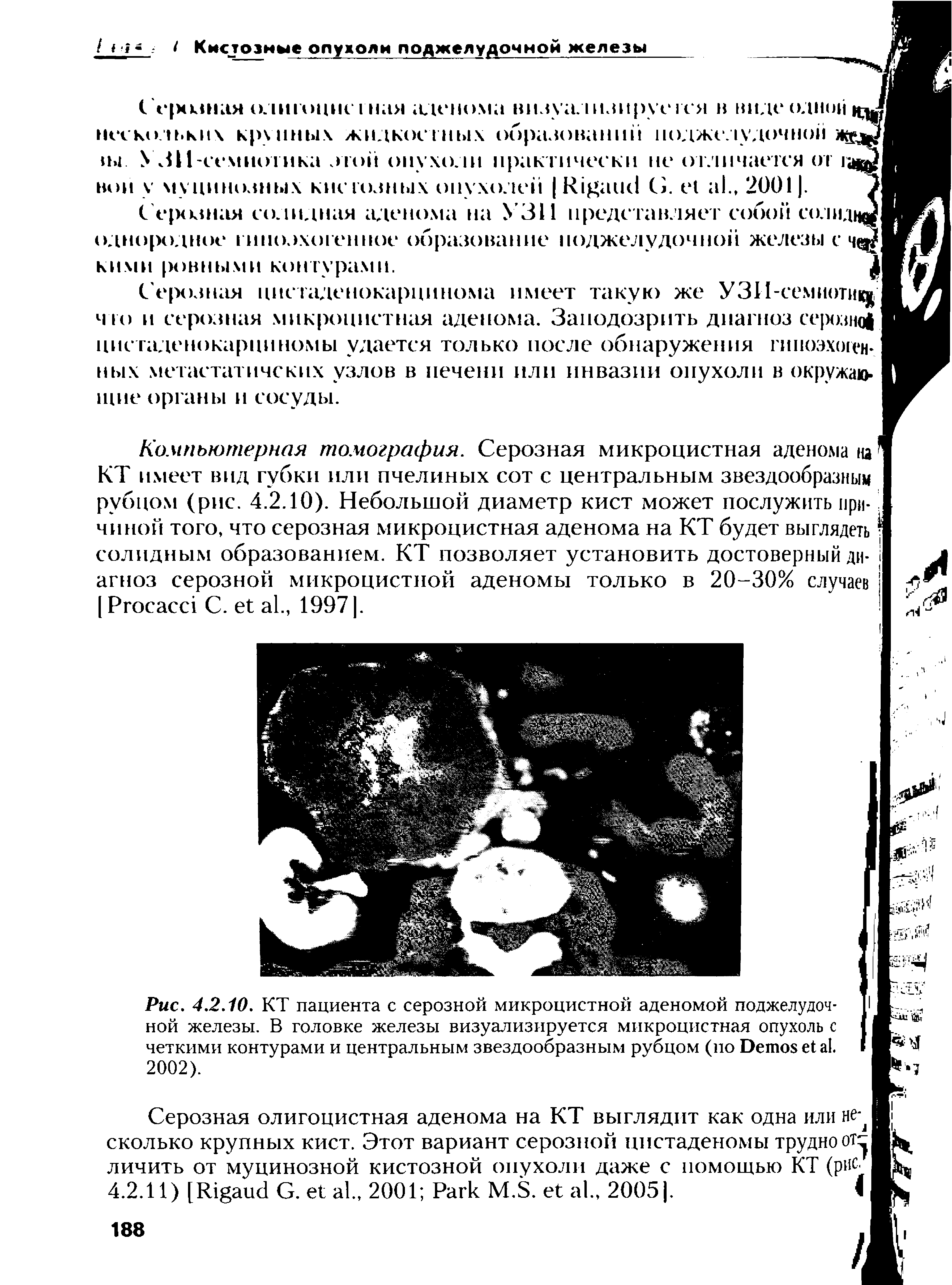 Рис. 4.2.10. КТ пациента с серозной микроцистной аденомой поджелудочной железы. В головке железы визуализируется микроцистная опухоль с четкими контурами и центральным звездообразным рубцом (по D . 2002).