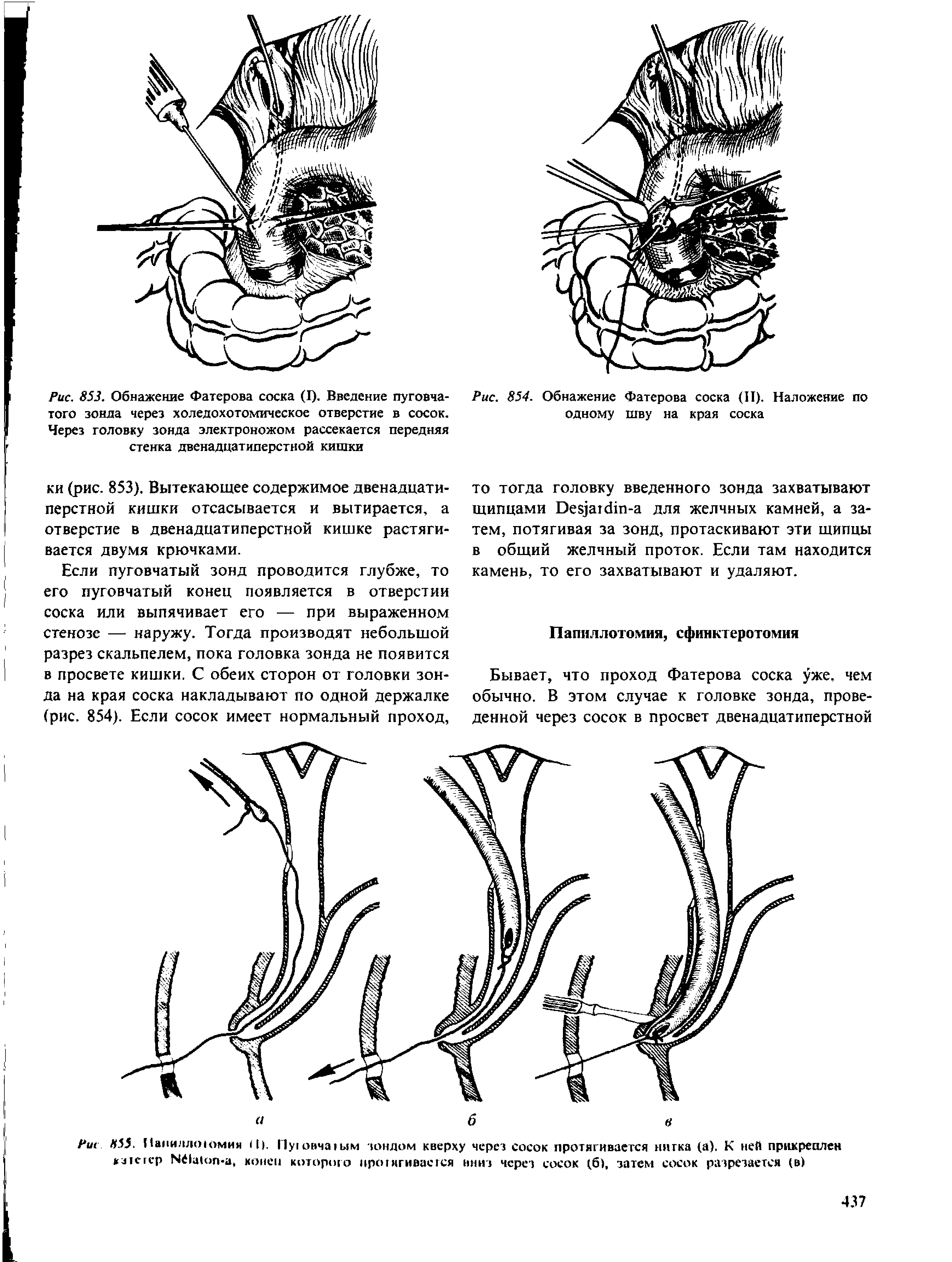 Рис. 854. Обнажение Фатерова соска (II). Наложение по одному шву на края соска...