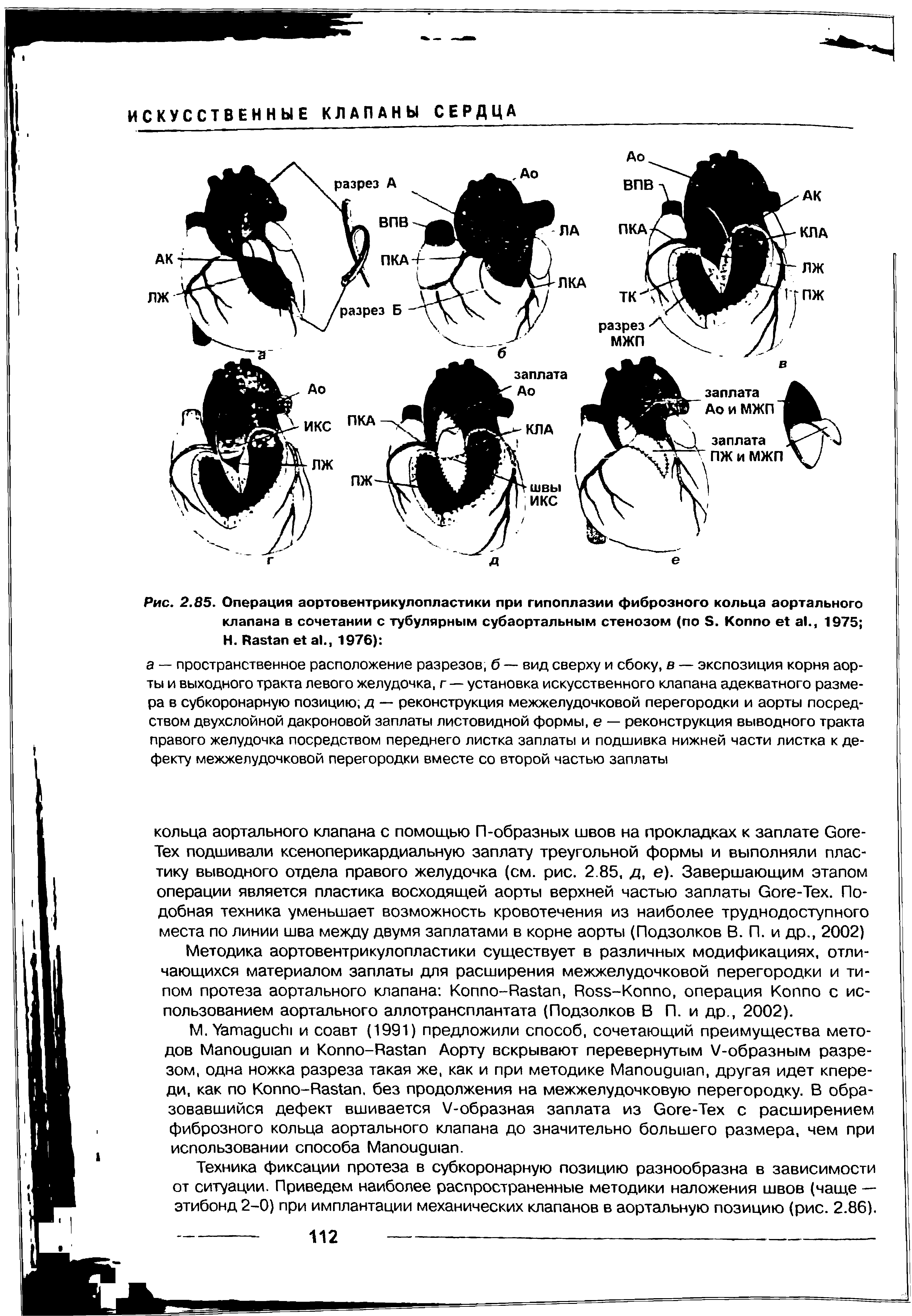 Рис. 2.85. Операция аортовентрикулопластики при гипоплазии фиброзного кольца аортального клапана в сочетании с тубулярным субаортальным стенозом (по в. Коппо е1 а1., 1975 Н. Иаз1ап е а1., 1976) ...