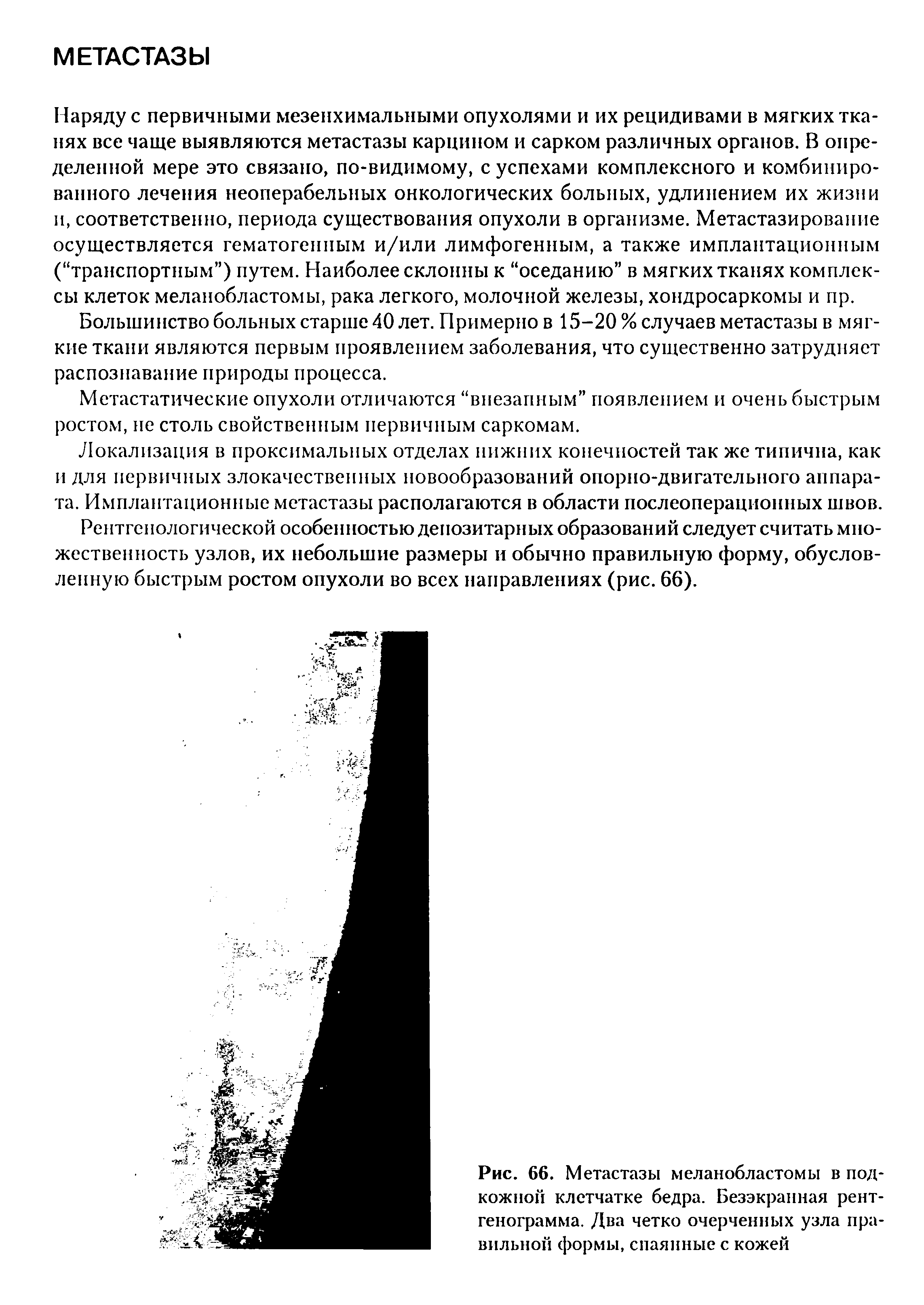 Рис. 66. Метастазы меланобластомы в подкожной клетчатке бедра. Безэкранная рентгенограмма. Два четко очерченных узла правильной формы, спаянные с кожей...