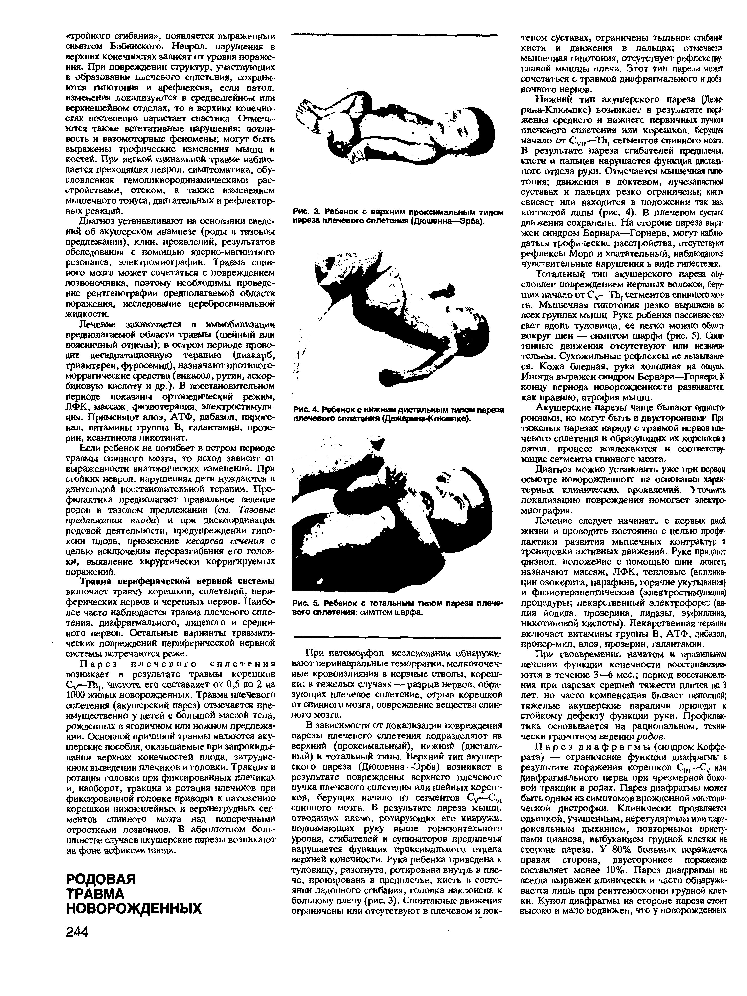 Рис. 3. Ребенок с верхним проксимальным типом пареза плечевого сплетения (Дюшенна—Эрба).