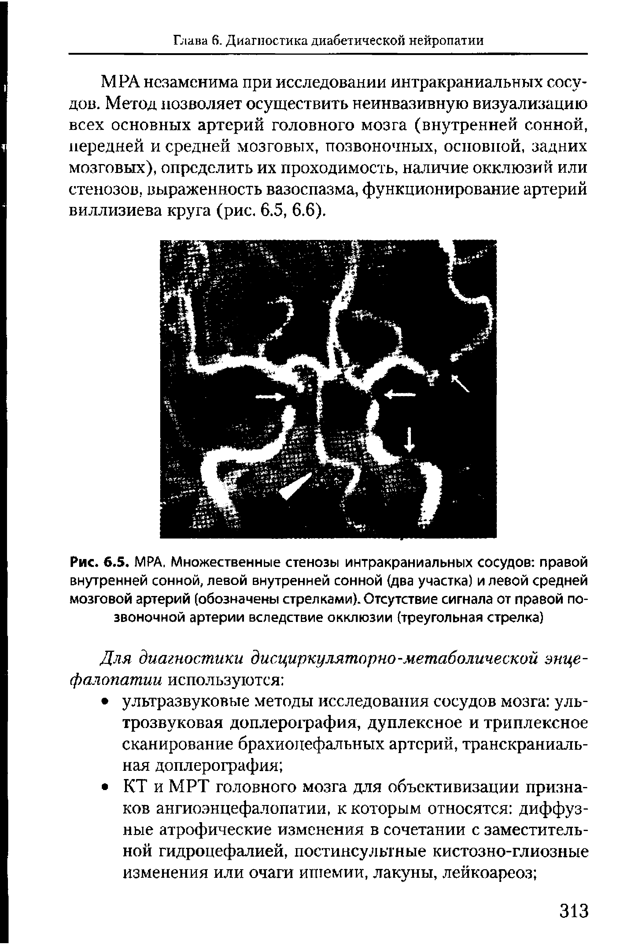 Рис. 6.5. МРА, Множественные стенозы интракраниальных сосудов правой внутренней сонной, левой внутренней сонной (два участка) и левой средней мозговой артерий (обозначены стрелками). Отсутствие сигнала от правой позвоночной артерии вследствие окклюзии (треугольная стрелка)...