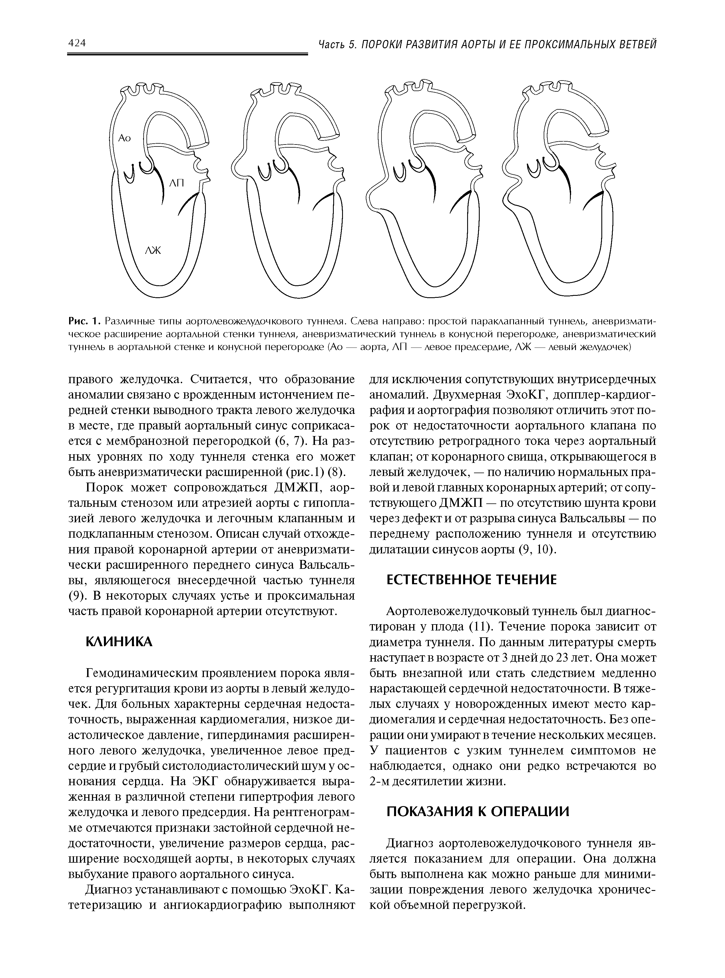 Рис. 1. Различные типы аортолевожелудочкового туннеля. Слева направо простой параклапанный туннель, аневризматическое расширение аортальной стенки туннеля, аневризматический туннель в конусной перегородке, аневризматический туннель в аортальной стенке и конусной перегородке (Ао — аорта, АП — левое предсердие, АЖ — левый желудочек)...