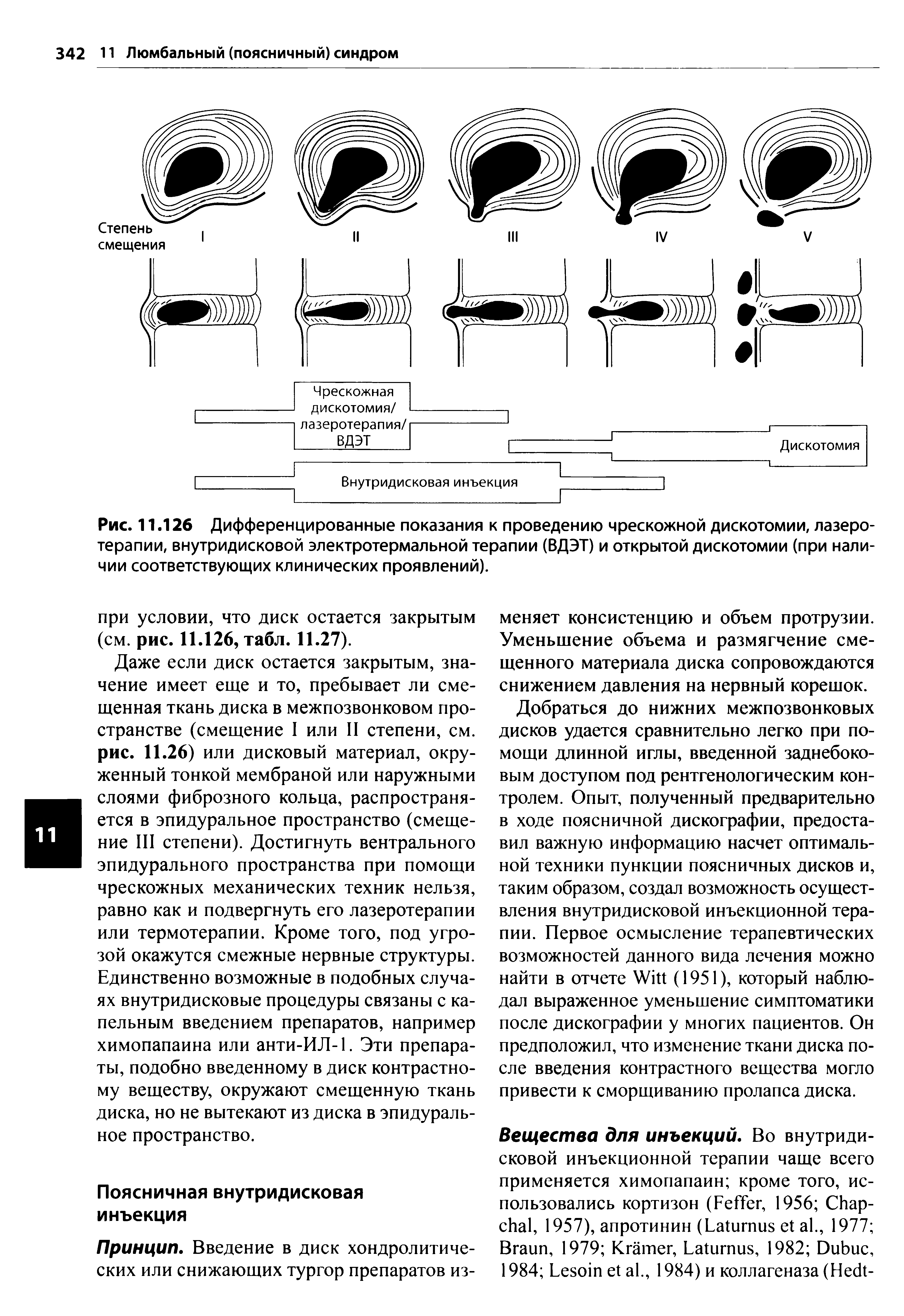 Рис. 11.126 Дифференцированные показания к проведению чрескожной дискотомии, лазеротерапии, внутридисковой электротермальной терапии (ВДЭТ) и открытой дискотомии (при наличии соответствующих клинических проявлений).