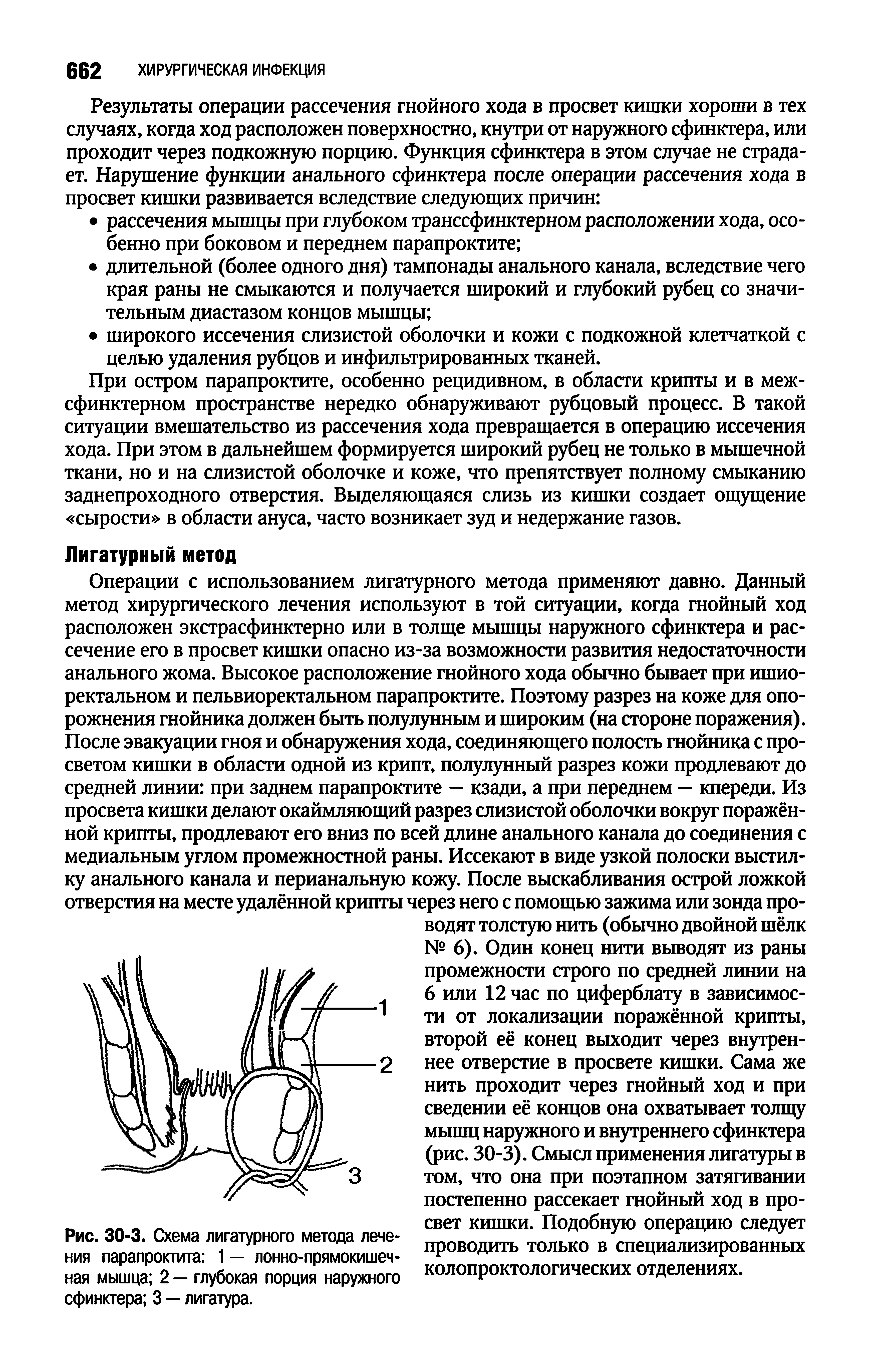 Рис. 30-3. Схема лигатурного метода лечения парапроктита 1 — лонно-прямокишечная мышца 2 — глубокая порция наружного...