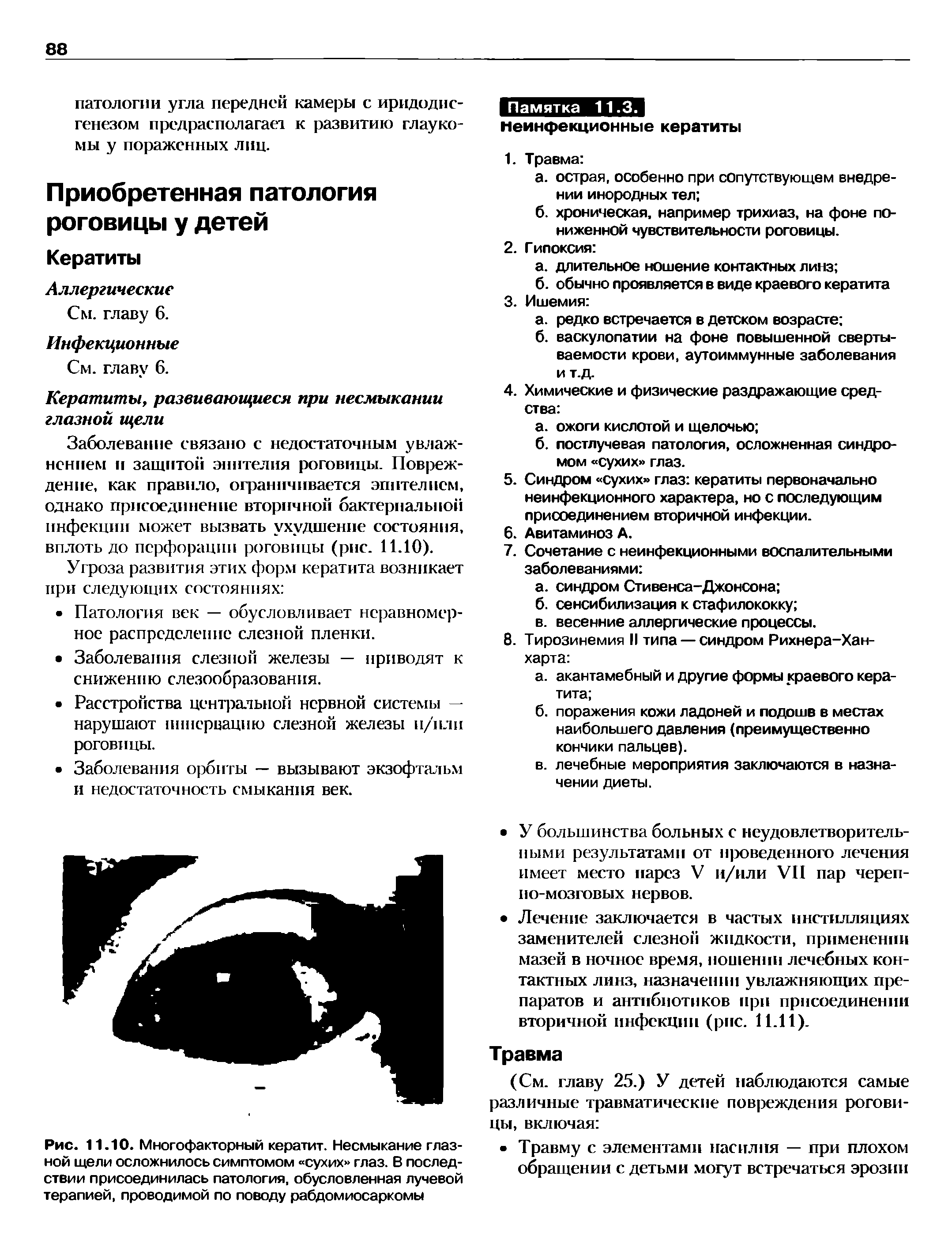 Рис. 11.10. Многофакторный кератит. Несмыкание глазной щели осложнилось симптомом сухих глаз. В последствии присоединилась патология, обусловленная лучевой терапией, проводимой по поводу рабдомиосаркомы...