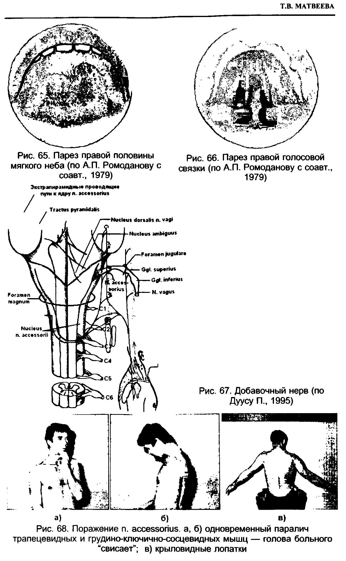 Рис. 68. Поражение п. , а, б) одновременный паралич трапецевидных и грудино-ключично-сосцевидных мышц — голова больного свисает в) крыловидные лопатки...