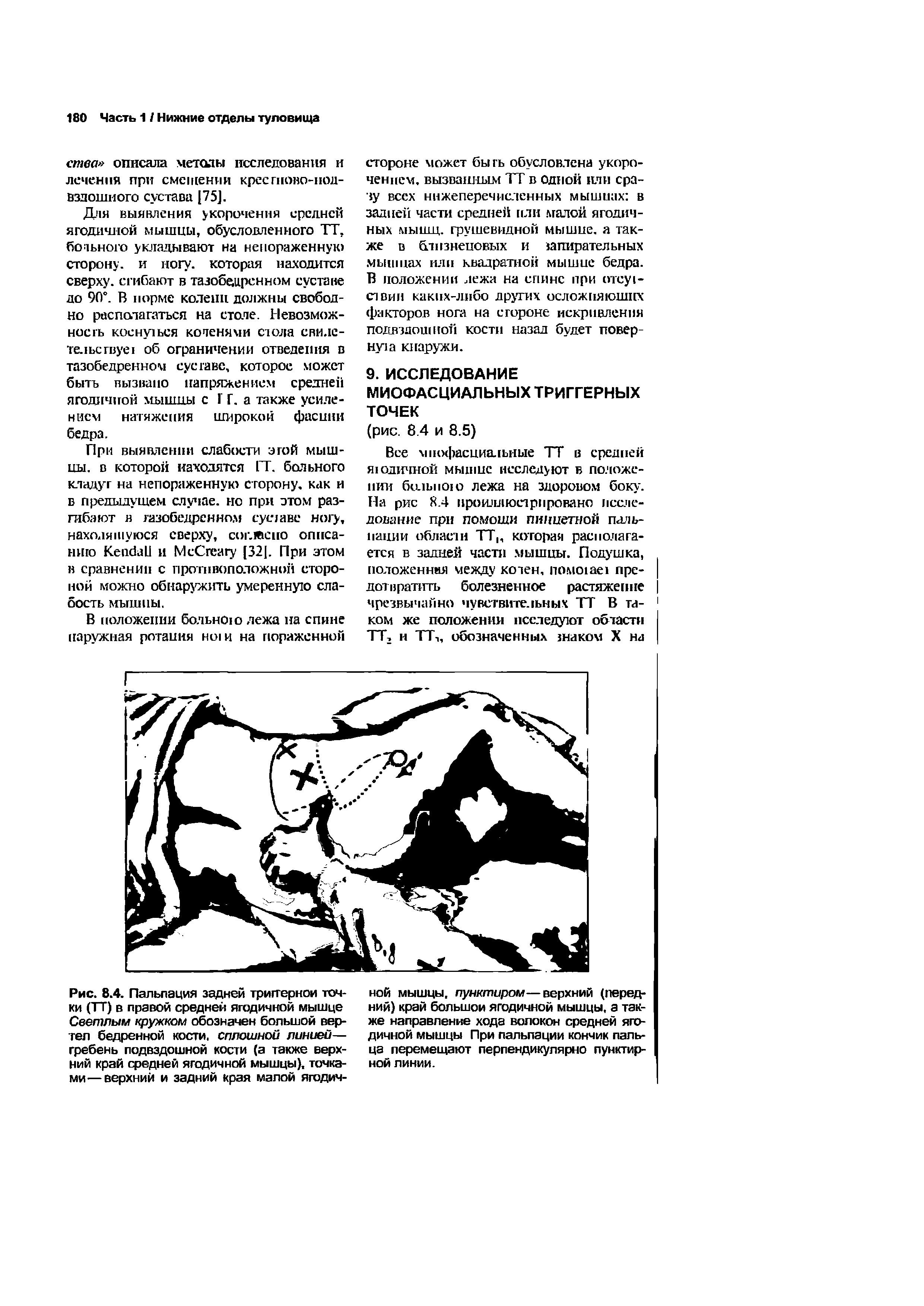 Рис. 8.4. Пальпация задней триггерном точки (ТТ) в правой средней ягодичной мышце Светлым кружком обозначен большой вертел бедренном кости, сплошной линией— гребень подвздошной кости (а также верхний край средней ягодичной мышцы), точками— верхний и задний края малой ягодич...