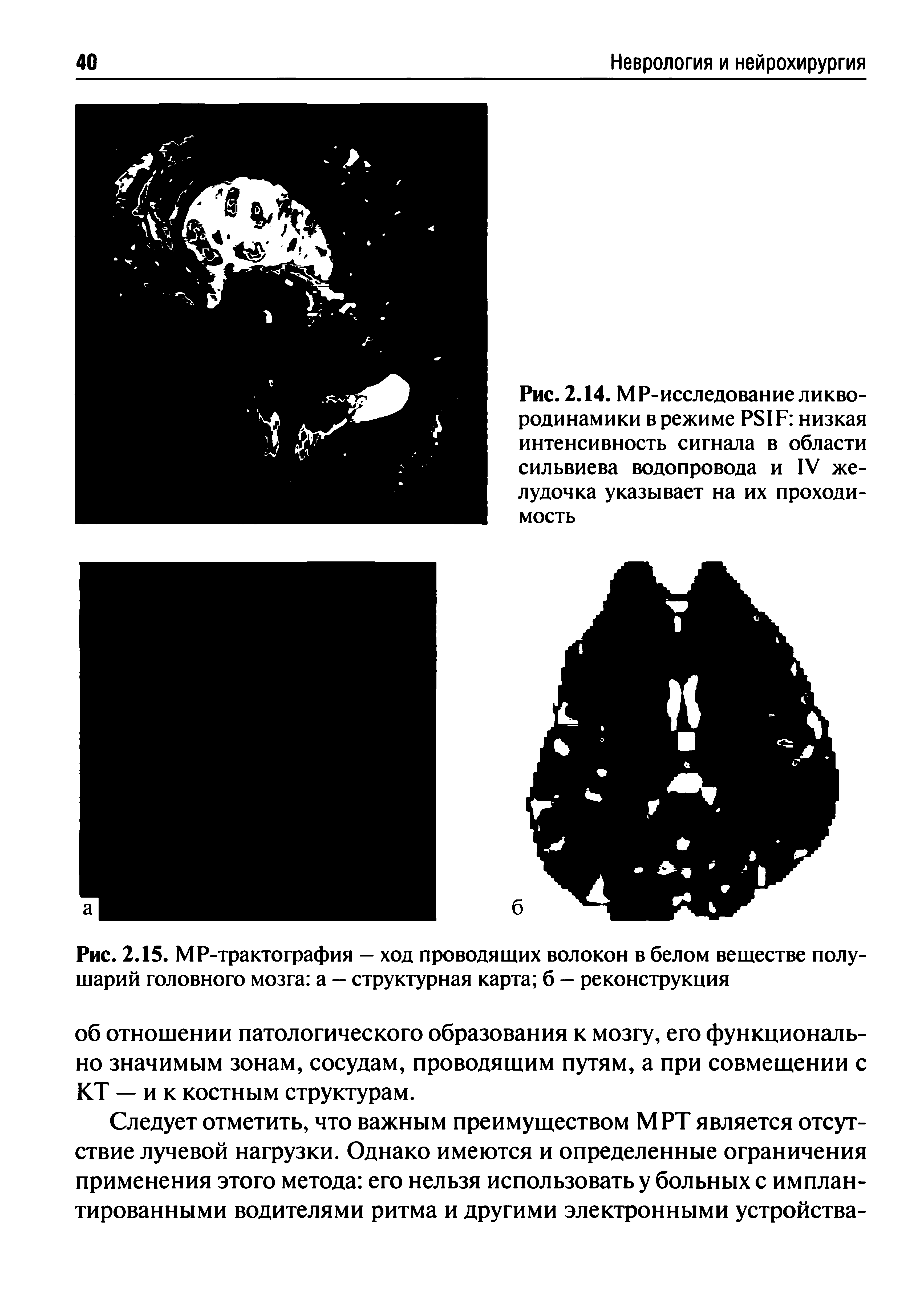 Рис. 2.15. МР-трактография — ход проводящих волокон в белом веществе полушарий головного мозга а - структурная карта б - реконструкция...