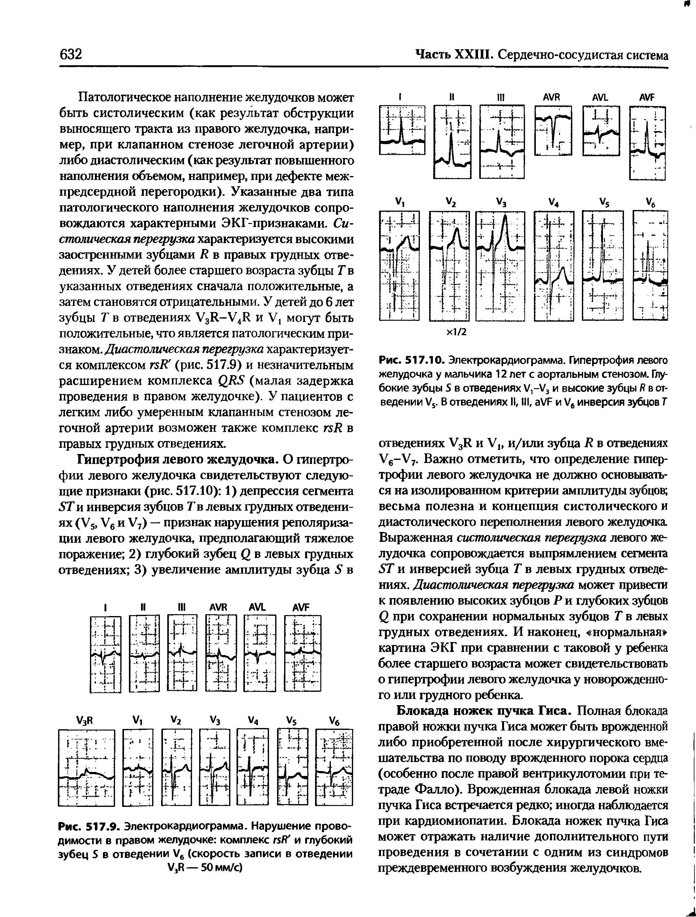 Рис. 517.10. Электрокардиограмма. Гипертрофия левого желудочка у мальчика 12 лет с аортальным стенозом. Глубокие зубцы S в отведениях V,-V3 и высокие зубцы R в отведении V5. В отведениях II, III, VF и V6 инверсия зубцов Г...