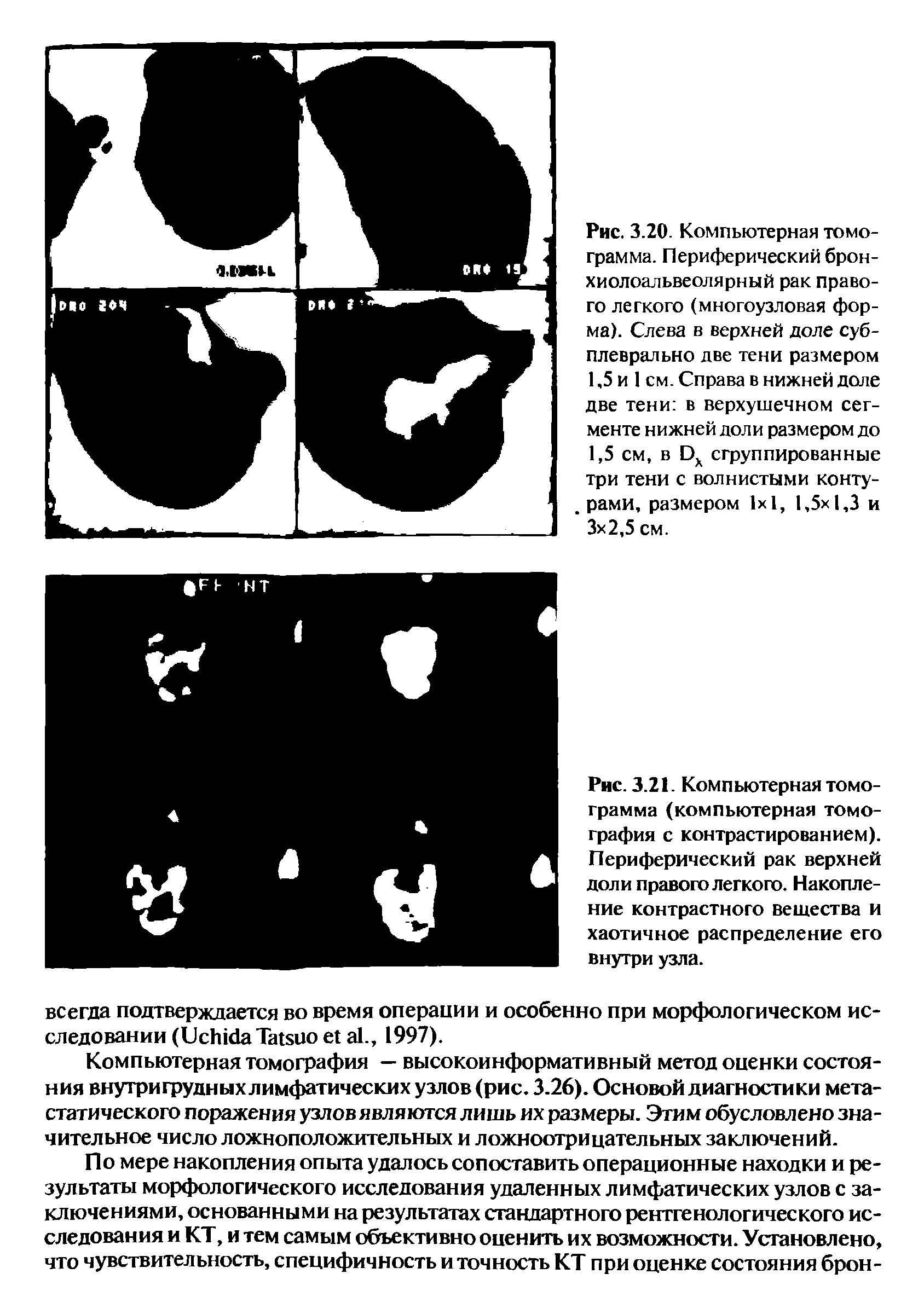 Рис. 3.21. Компьютерная томограмма (компьютерная томография с контрастированием). Периферический рак верхней доли правого легкого. Накопление контрастного вещества и хаотичное распределение его внутри узла.