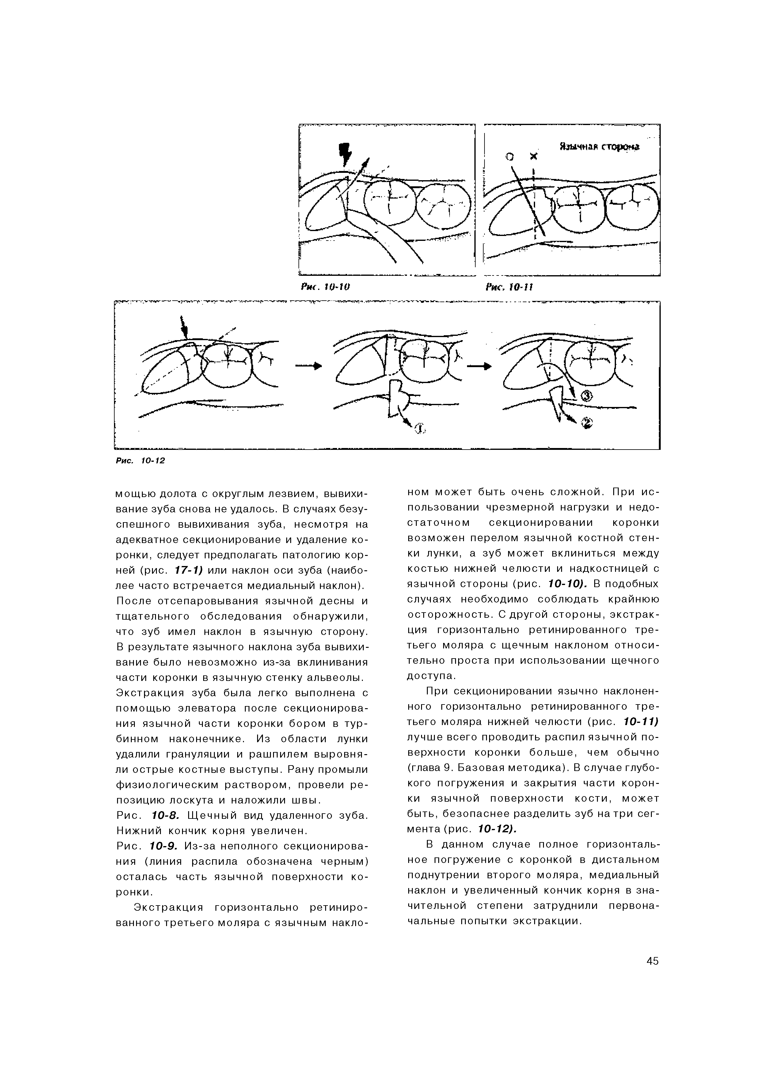 Рис. 10-8. Щеч ный вид удаленного зуба. Нижний кончик корня увеличен.