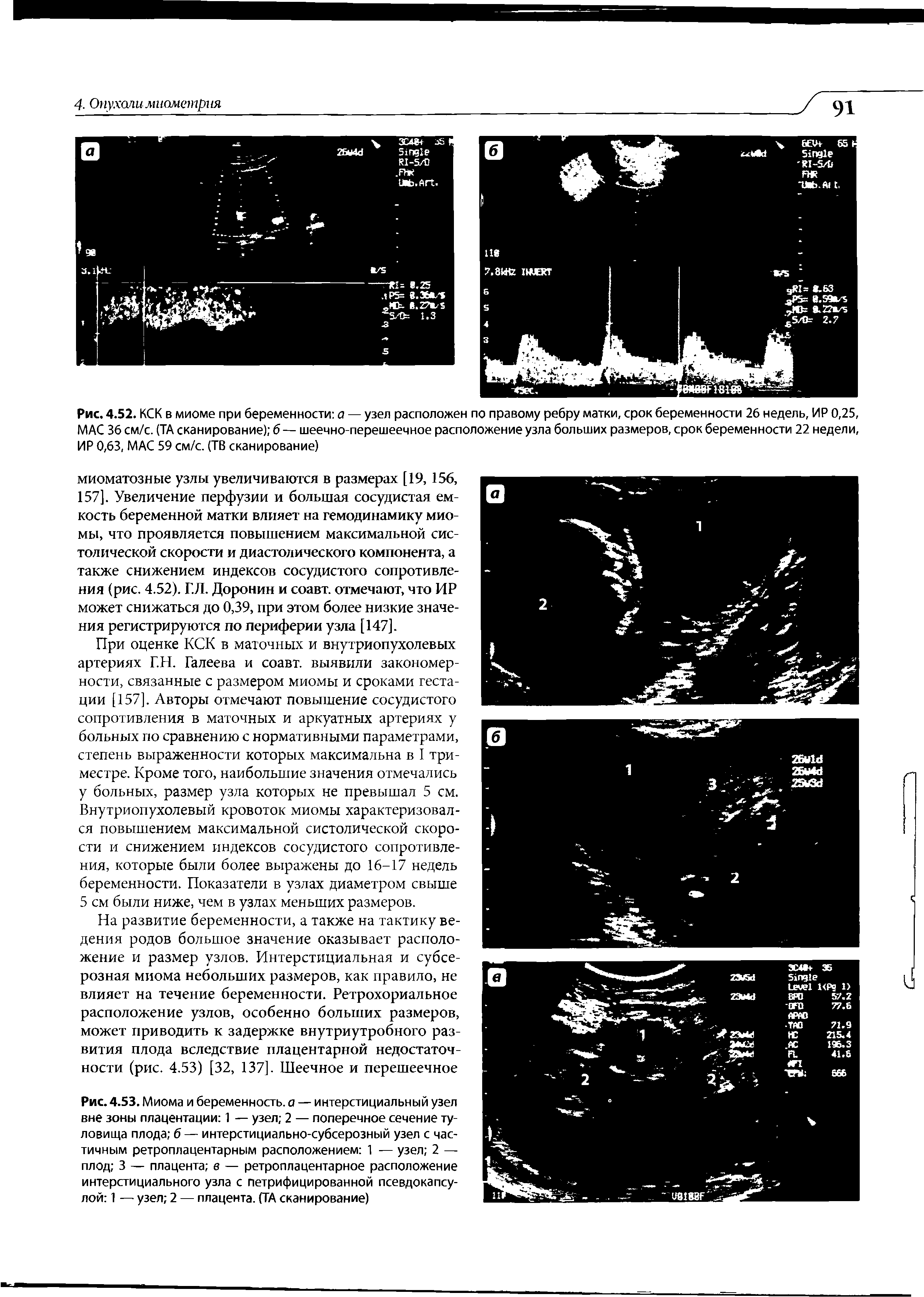 Рис. 4.53. Миома и беременность, а — интерстициальный узел вне зоны плацентации 1 — узел 2 — поперечное сечение туловища плода б — интерстициально-субсерозный узел с частичным ретроплацентарным расположением 1 — узел 2 — плод 3 — плацента в — ретроплацентарное расположение интерстициального узла с петрифицированной псевдокапсулой 1 — узел 2 — плацента. (ТА сканирование)...