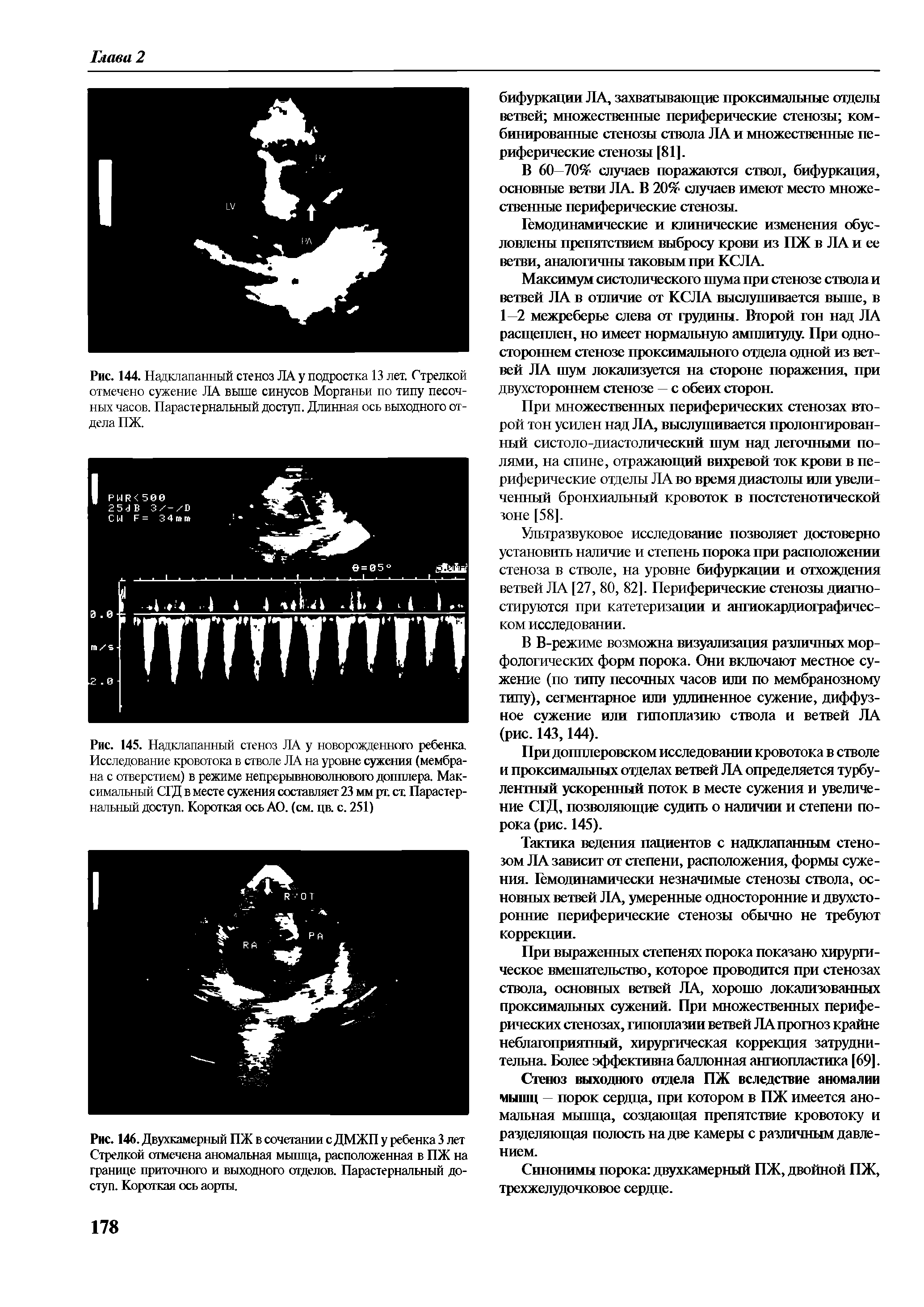 Рис. 145. Надклапанный стеноз ЛА у новорожденного ребенка. Исследование кровотока в стволе ЛА на уровне сужения (мембрана с отверстием) в режиме непрерывноволнового допплера. Максимальный СГД в месте сужения составляет 23 мм рг. ст Парастер-налвный доступ. Короткая ось АО. (см. цв. с. 251)...