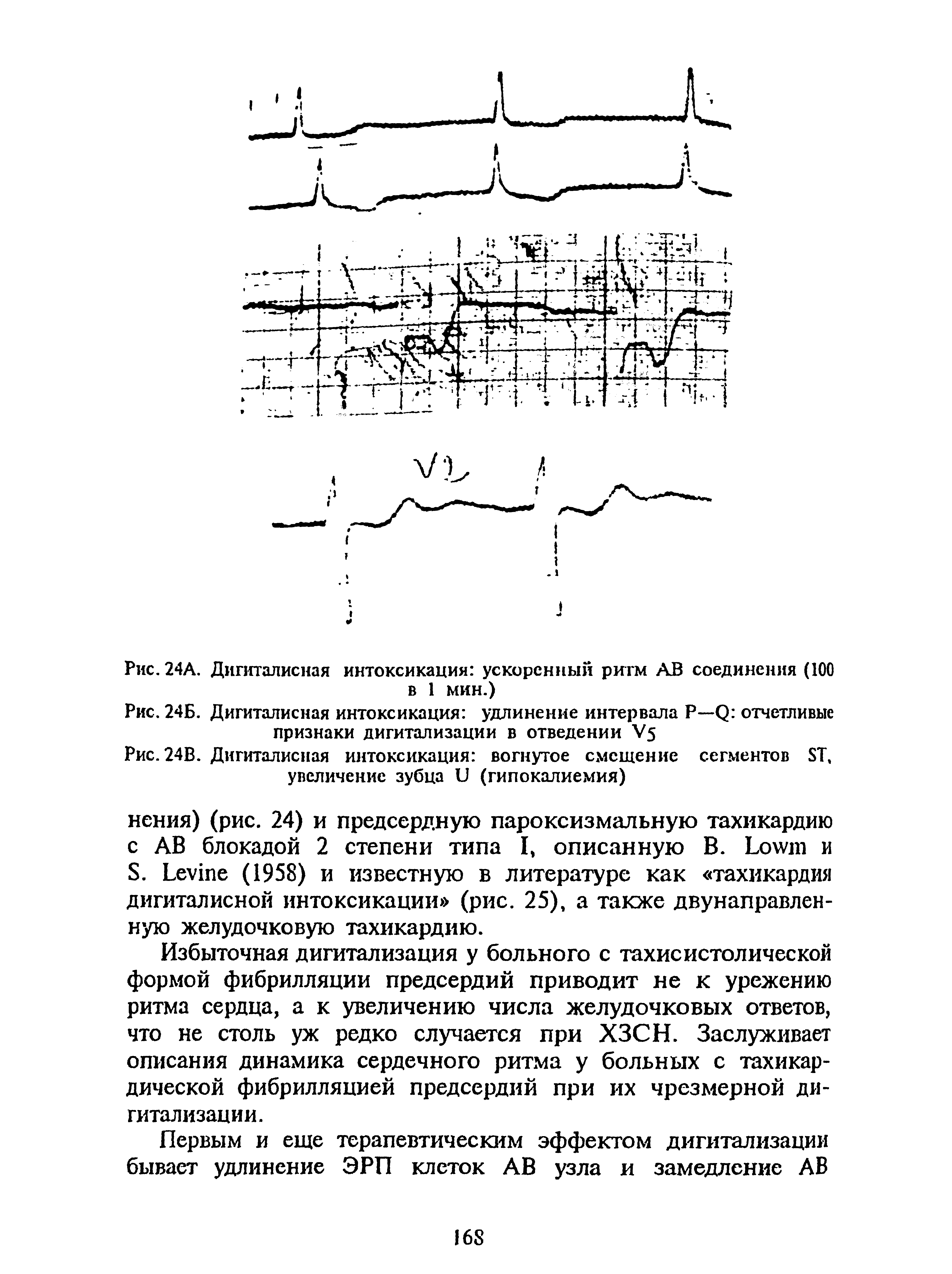 Рис. 24Б. Дигиталисная интоксикация удлинение интервала Р—Q отчетливые признаки дигитализации в отведении V5...