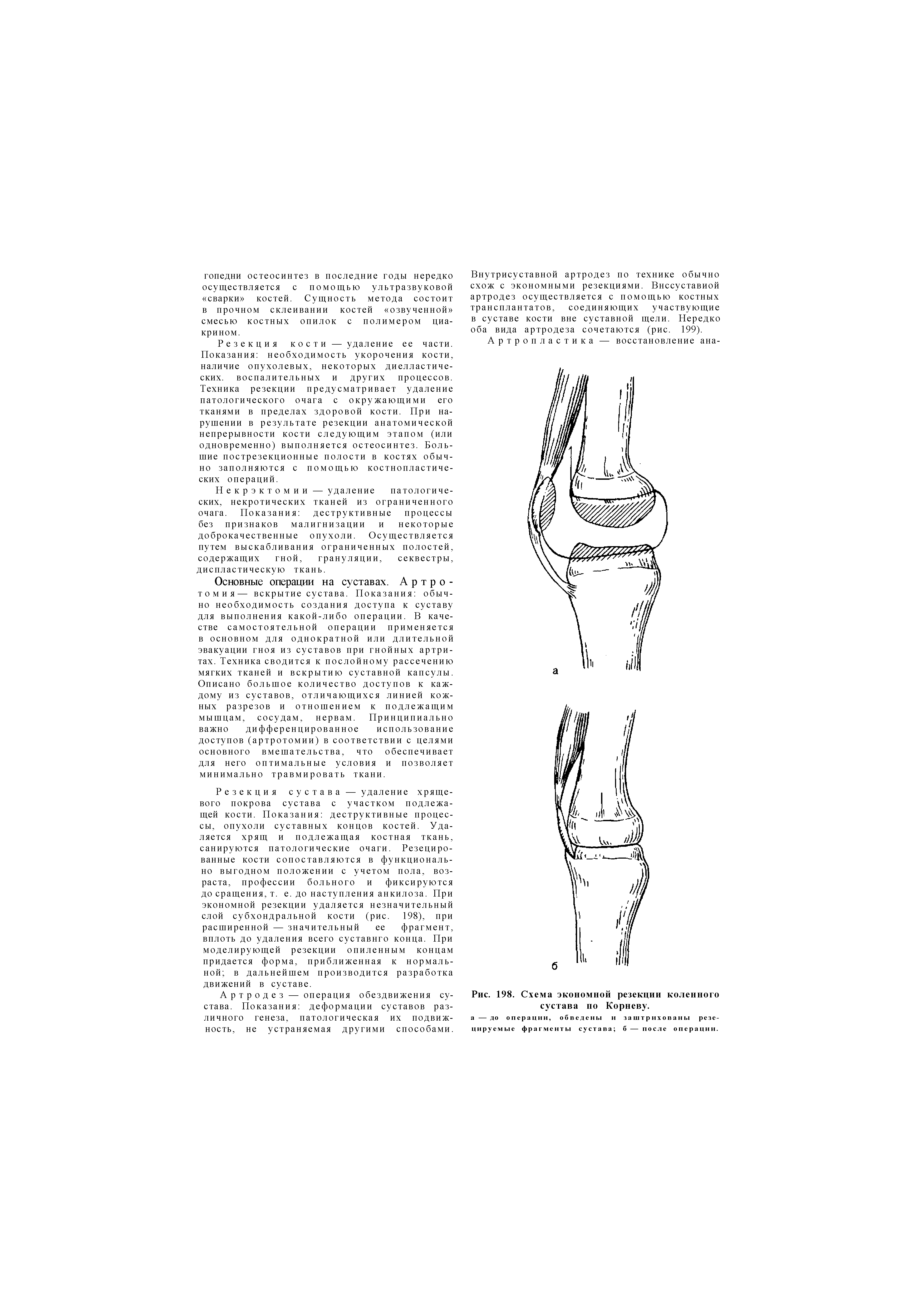 Рис. 198. Схема экономной резекции коленного сустава по Корневу.