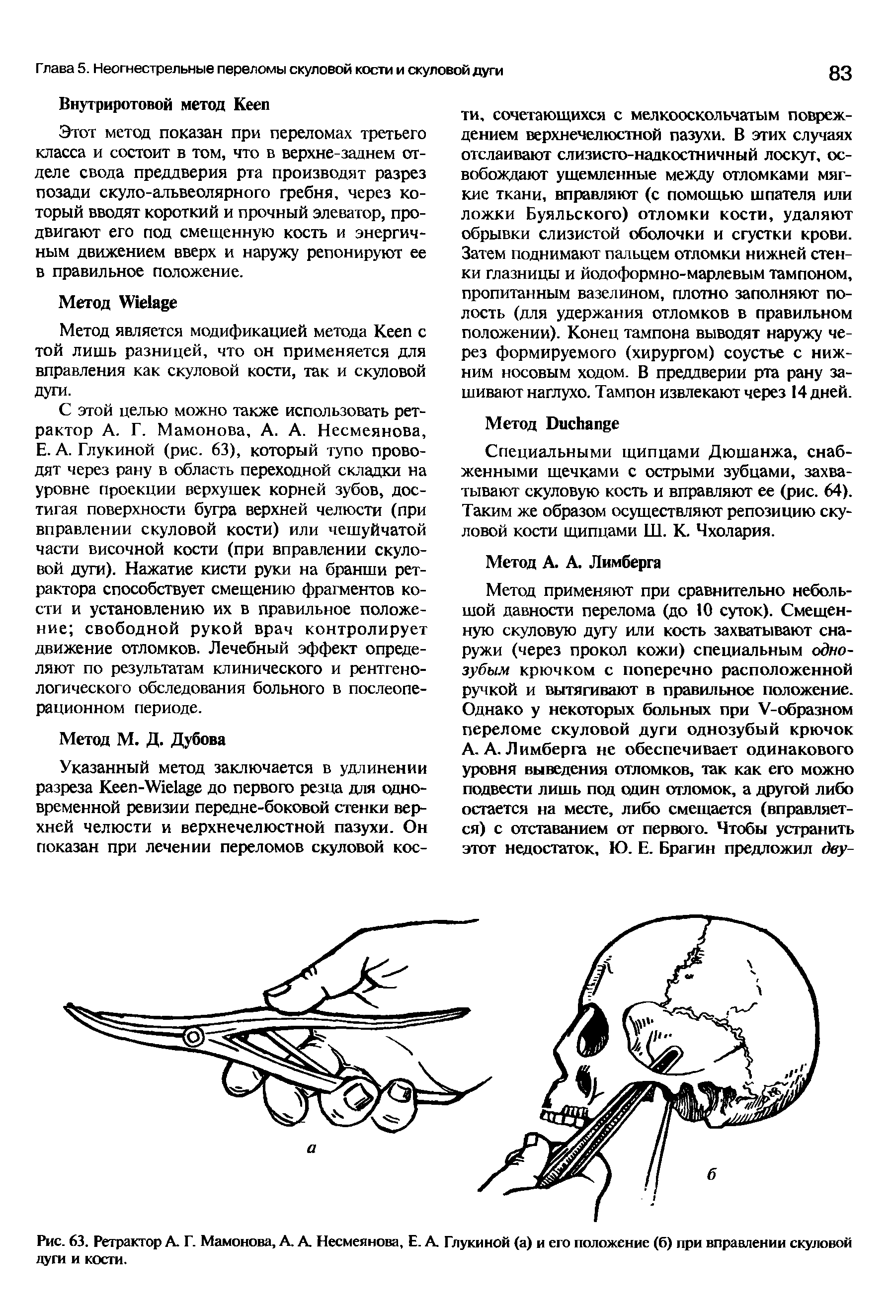 Рис. 63. Ретрактор А Г. Мамонова, А. А Несмеянова, Е. А Глукиной (а) и его положение (б) при вправлении скуловой дуги и кости.