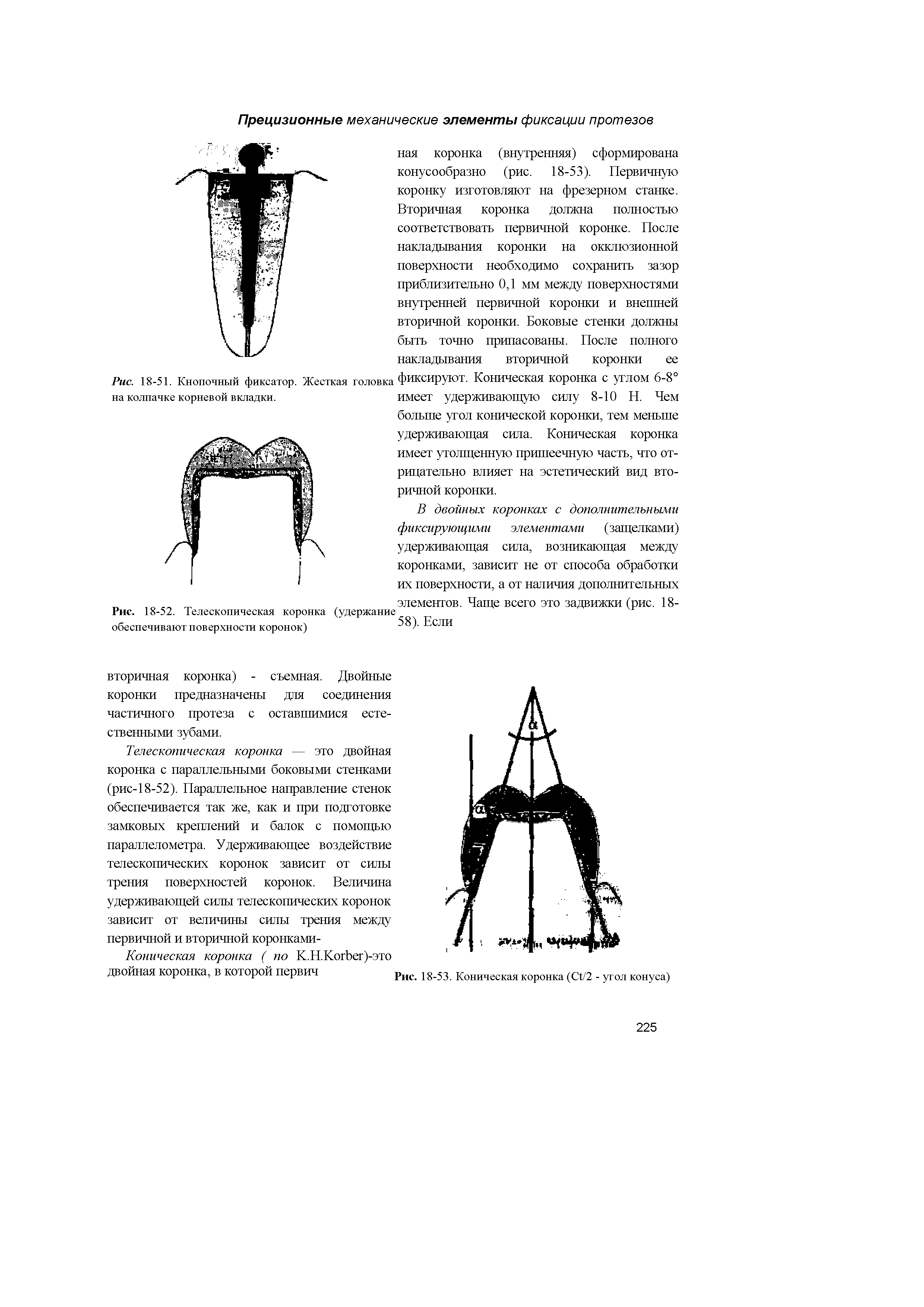 Рис. 18-51. Кнопочный фиксатор. Жесткая головка на колпачке корневой вкладки.